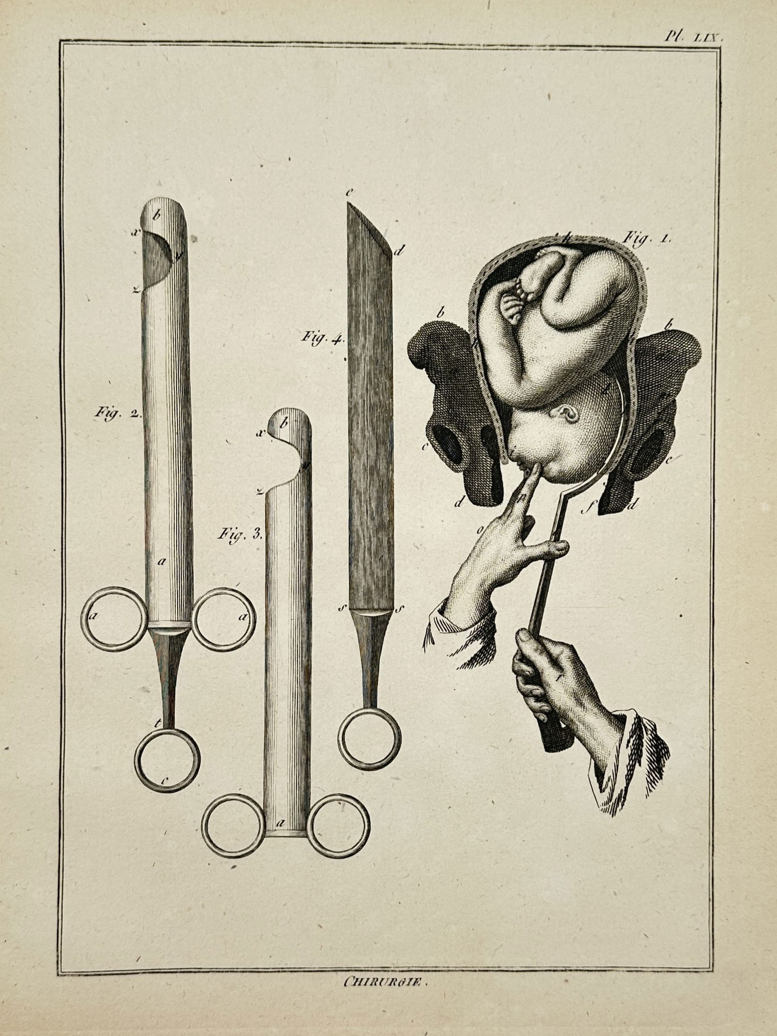 Robert Bénard (1734–1777) – Technical Illustration of Obstetric Forceps – Engraving (1771) (1 of 2)