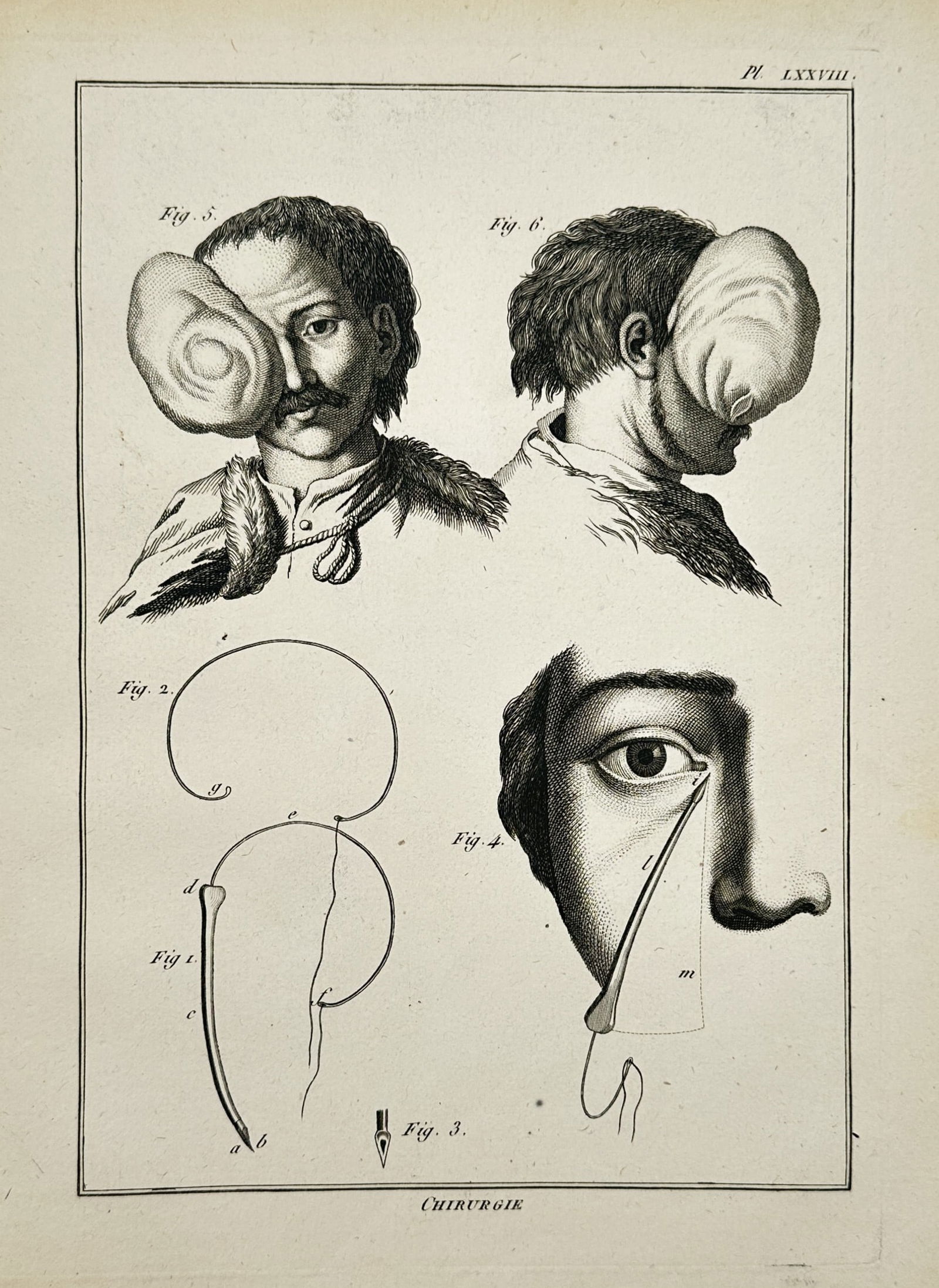 Robert Bénard (1734–1777) – Technical Illustration of Ophthalmic Surgery and Bandaging – (1 of 2)