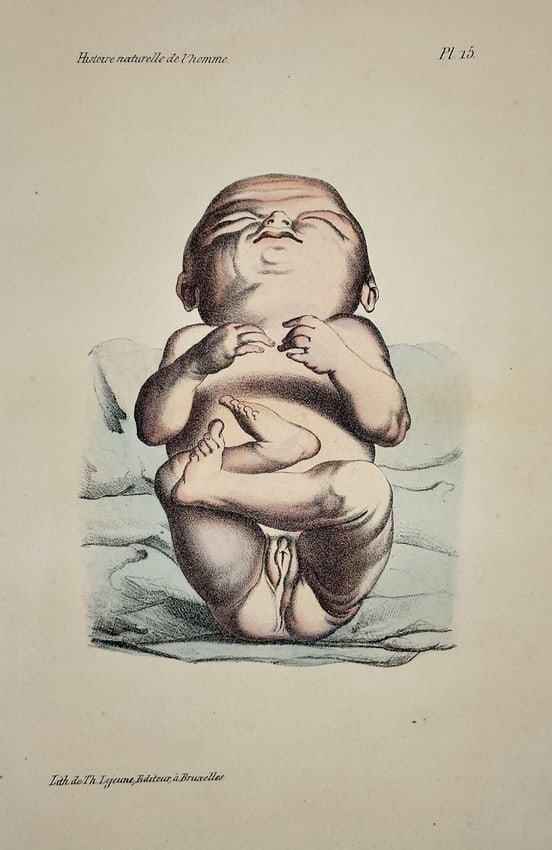 Georges-Louis Leclerc, Comte de Buffon – Infant with Anencephaly – Lithograph (1 of 2)