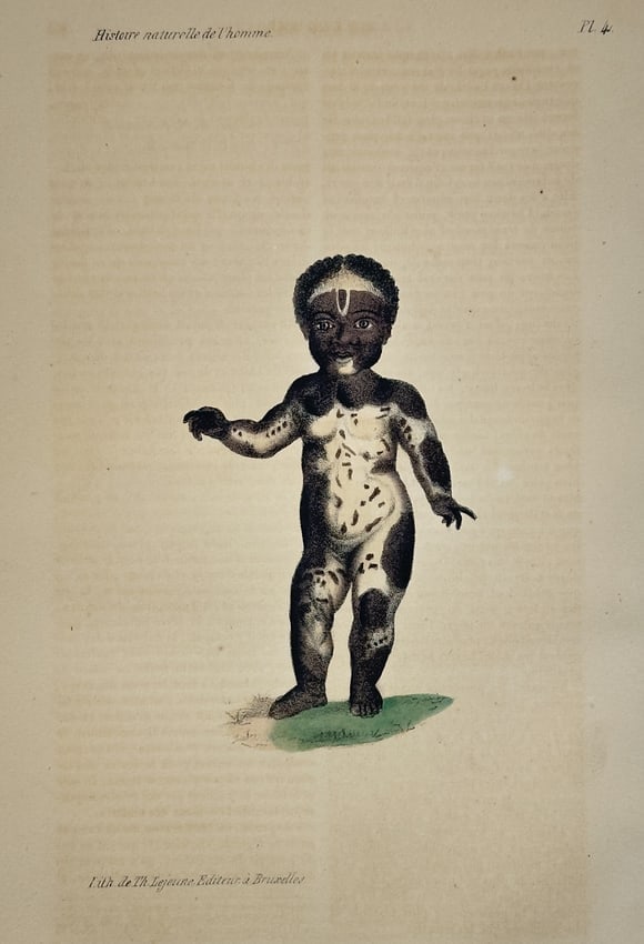 Georges-Louis Leclerc, Comte de Buffon – Child with Vitiligo – Lithograph: This lithograph features a classical representation of a young child with vitiligo, depicted in a standing pose against a small patch of grass. The work was published as part of a natural history seri