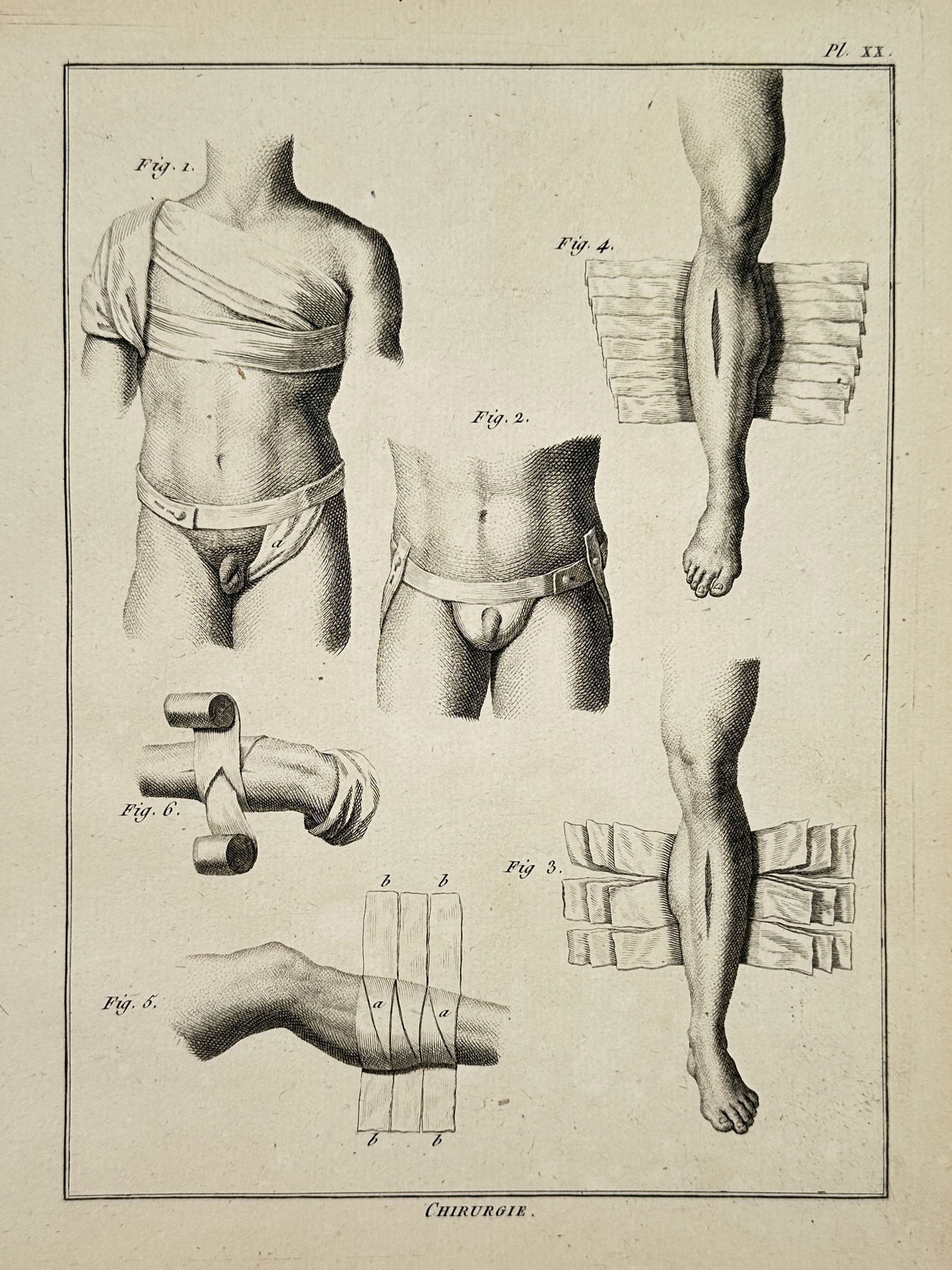 Robert Bénard (1734–1777) – Medical Illustration of Surgical Bandaging Techniques – Engraving (1 of 2)