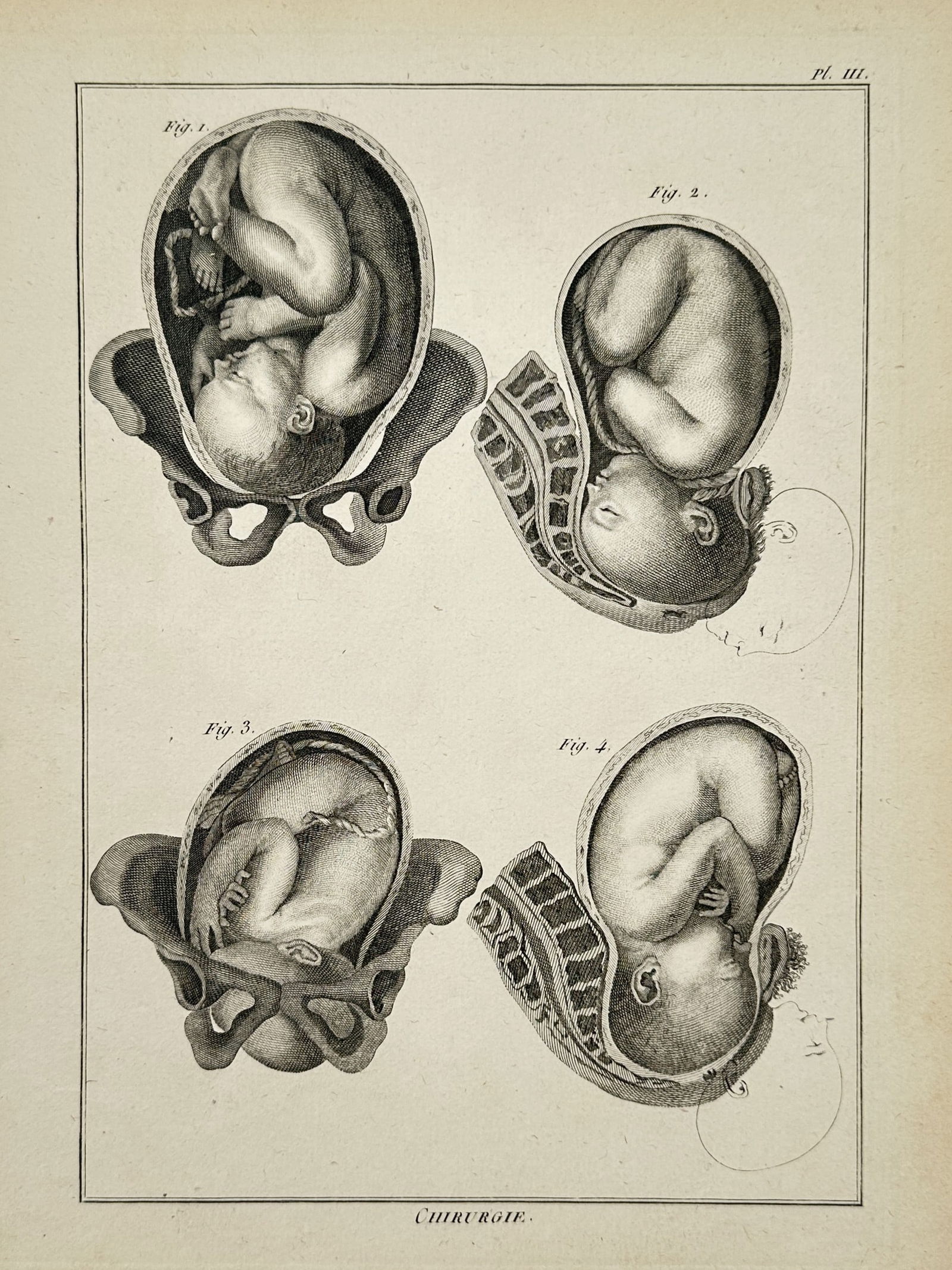 Robert Bénard (1734–1777) – Medical Illustration of Fetal Positioning – Engraving (1771): "Chirurgie." This engraving presents a significant anatomical and obstetric study from the eighteenth century, illustrating various fetal positions within the maternal pelvis. The plate features four