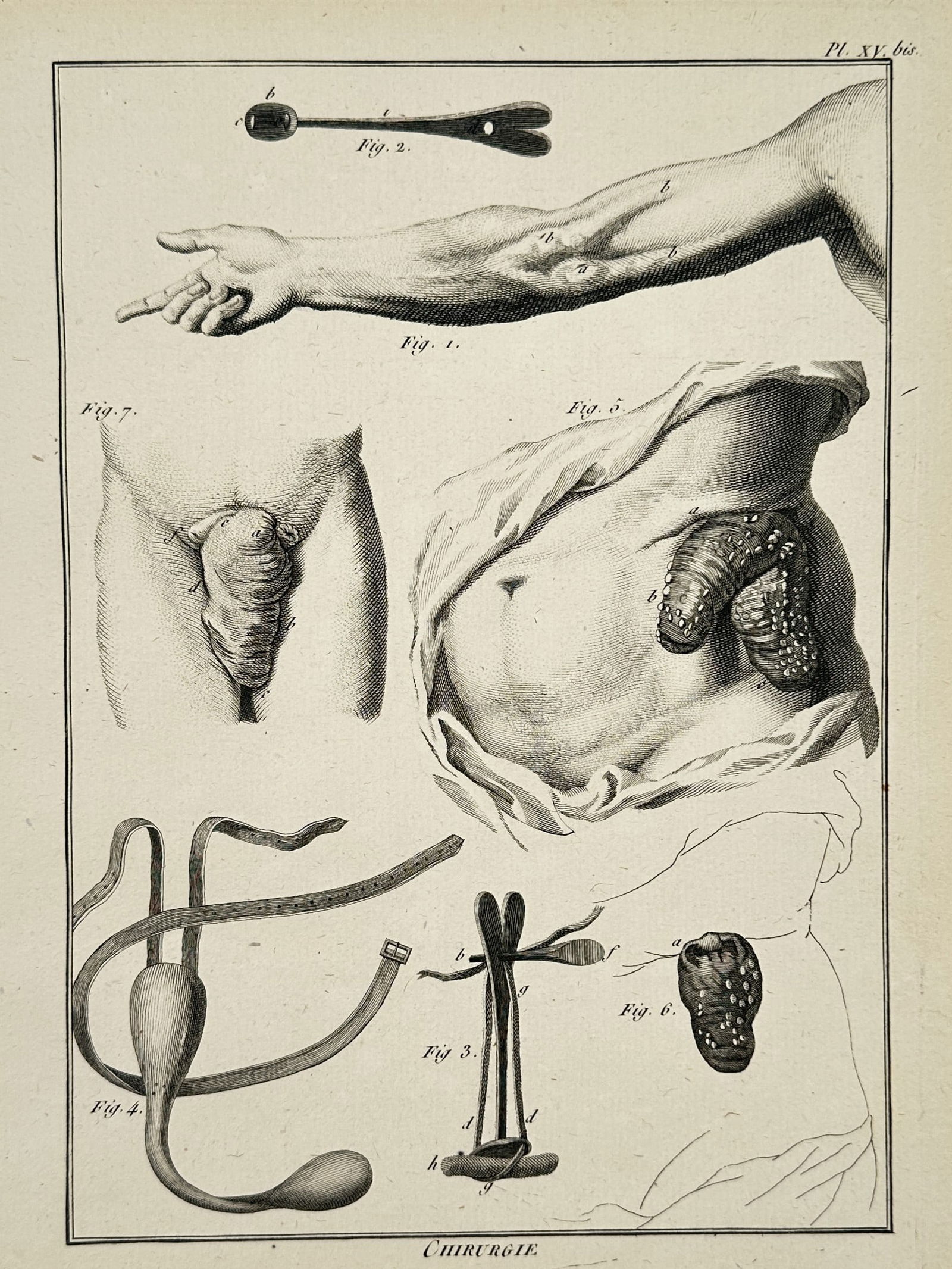 Robert Bénard (1734–1777) – Medical Illustration of Hernia Types and Surgical Trusses (1 of 2)