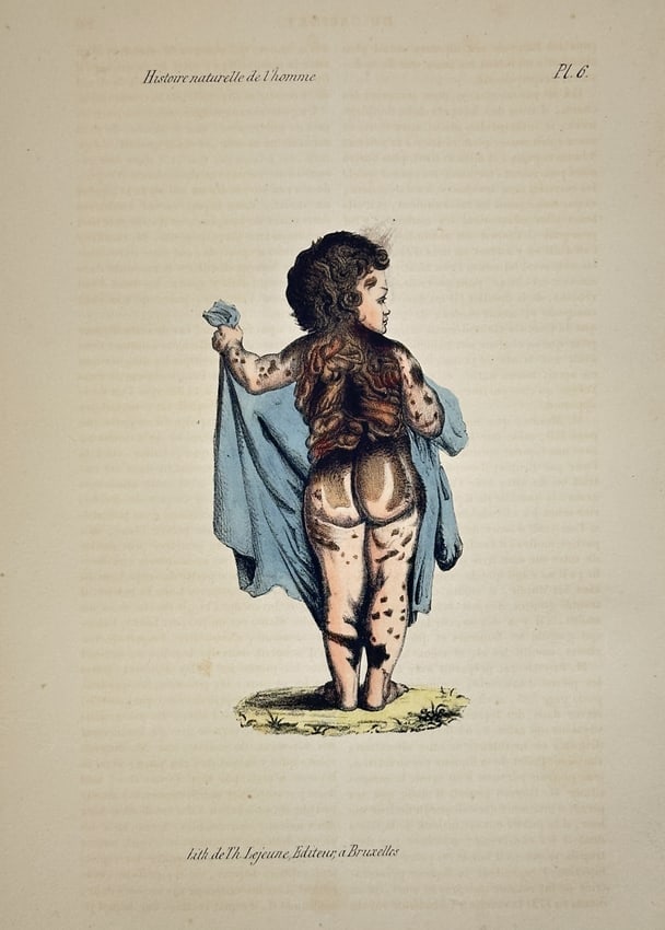 Georges-Louis Leclerc, Comte de Buffon – Young Woman with Hypertrichosis: This lithograph features a classical representation of a young woman with hypertrichosis, depicted from behind and draped in a blue cloth. The work was published as part of a natural history series ti