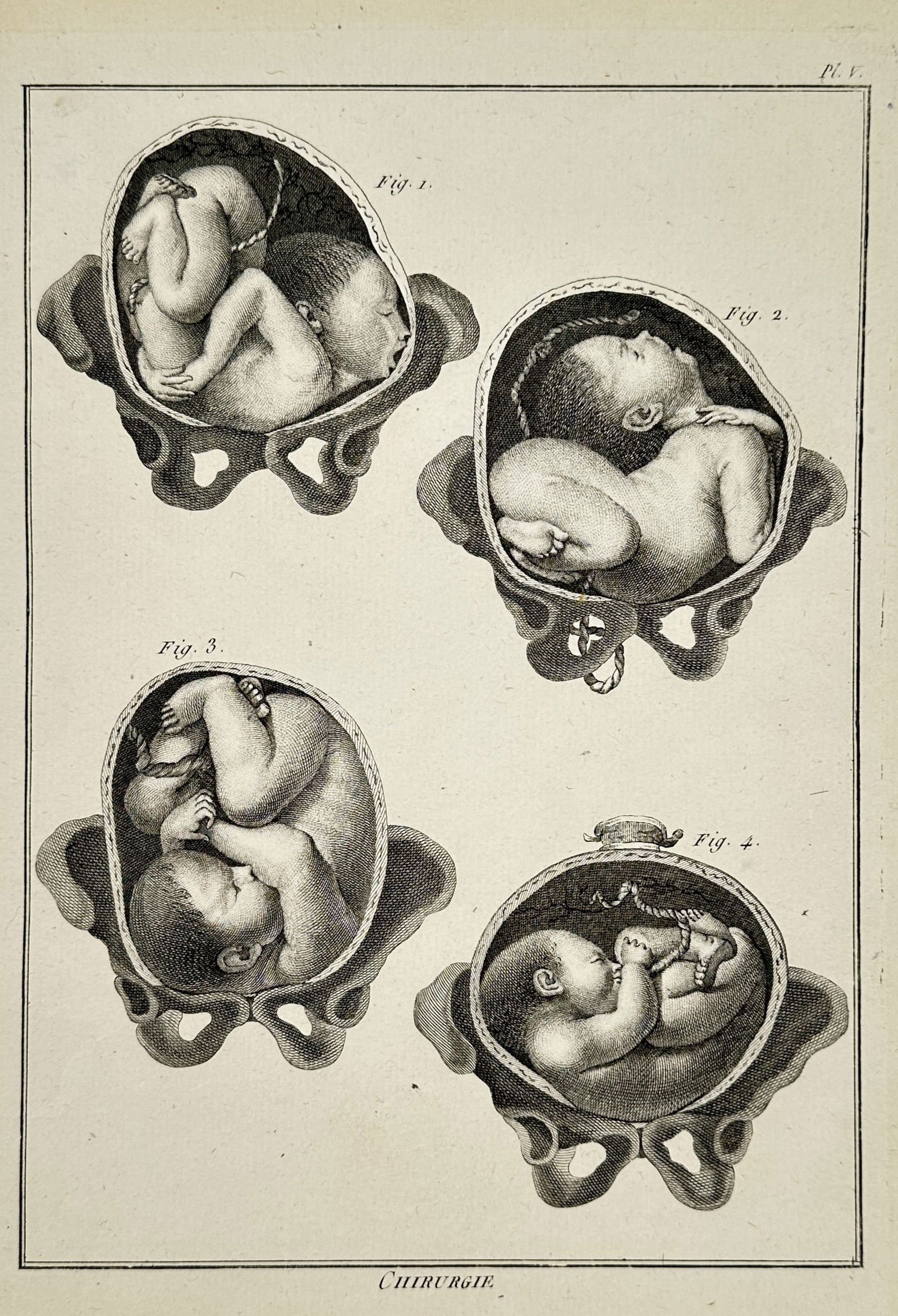 Robert Bénard (1734–1777) – Obstetrical Study of Fetal Positions in the Womb – Engraving (1 of 2)
