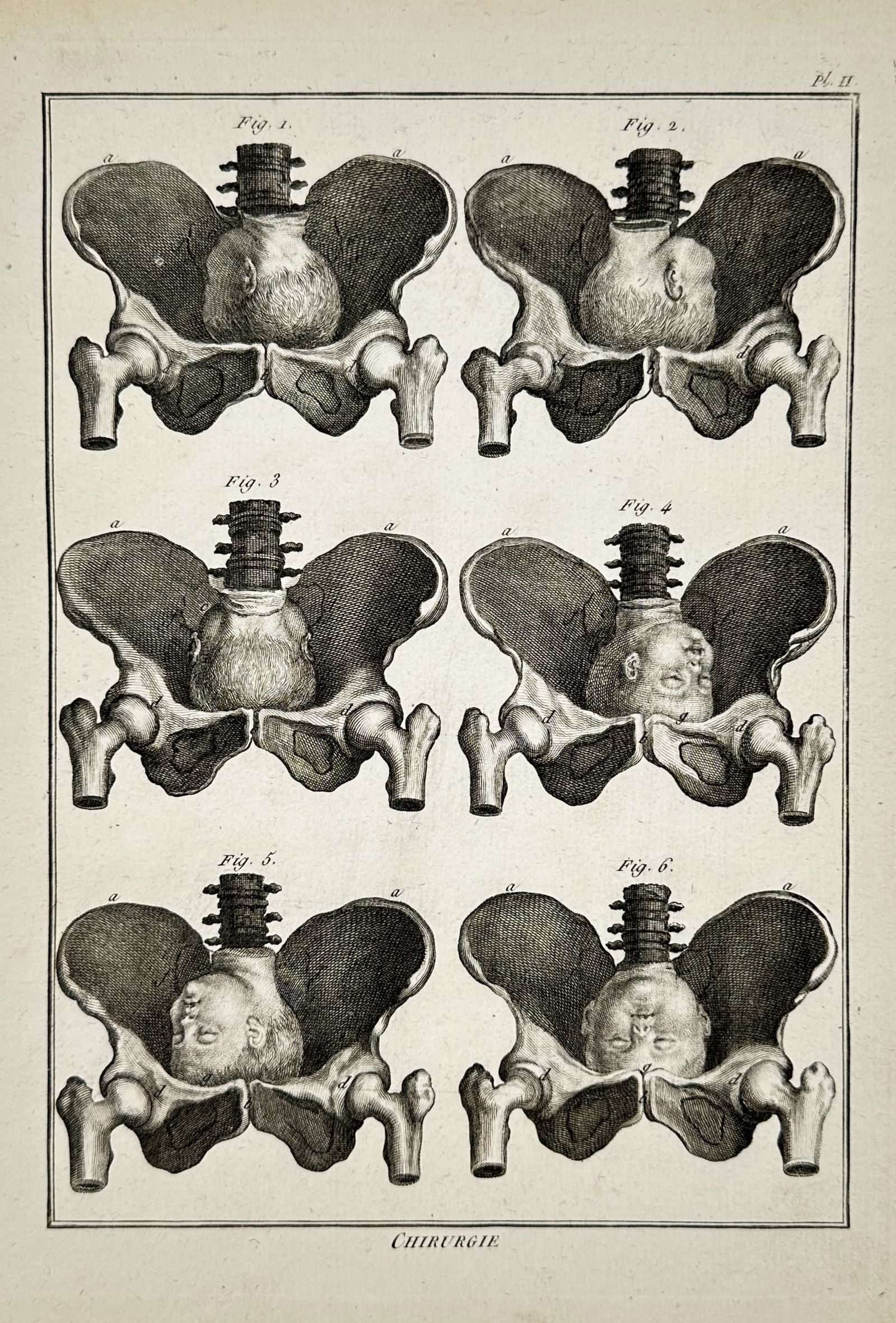 Robert Bénard (1734–1777) – Obstetrical Study of Fetal Presentation in the Pelvis – Engraving (1 of 2)