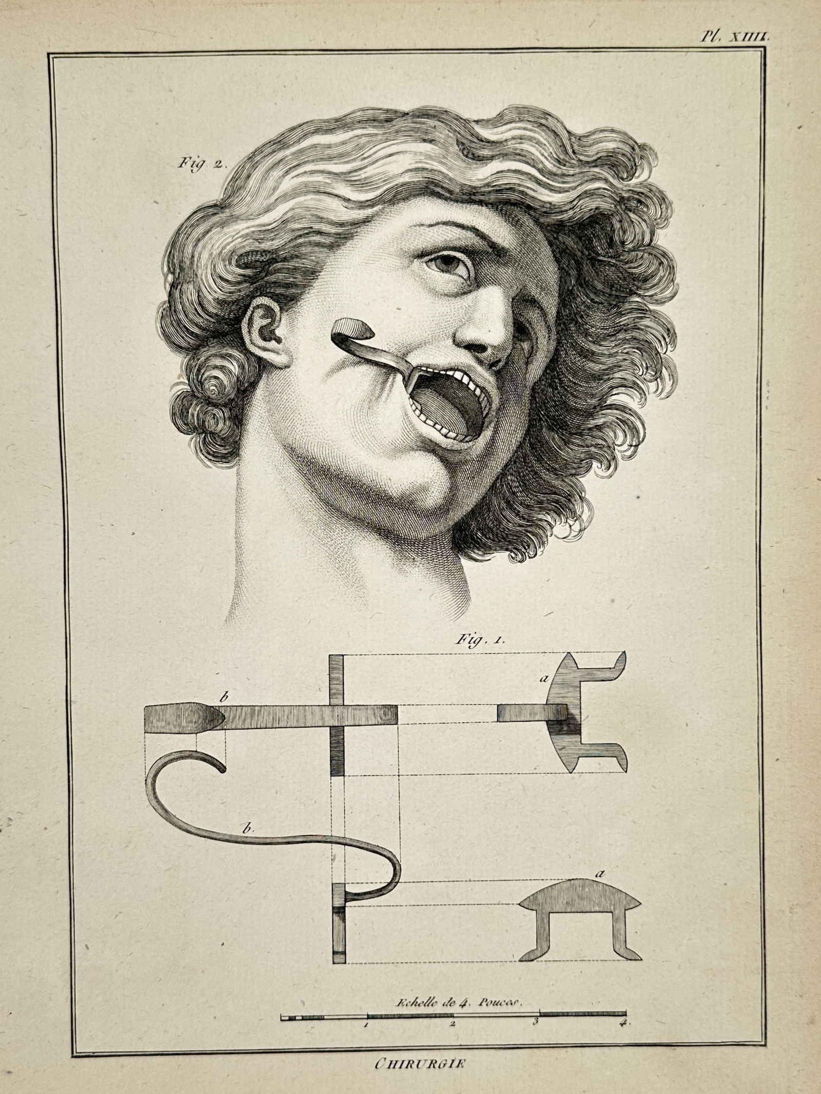 Robert Bénard (1734–1777) – Technical Study of a Mouth Speculum and Surgical Application – (1 of 2)