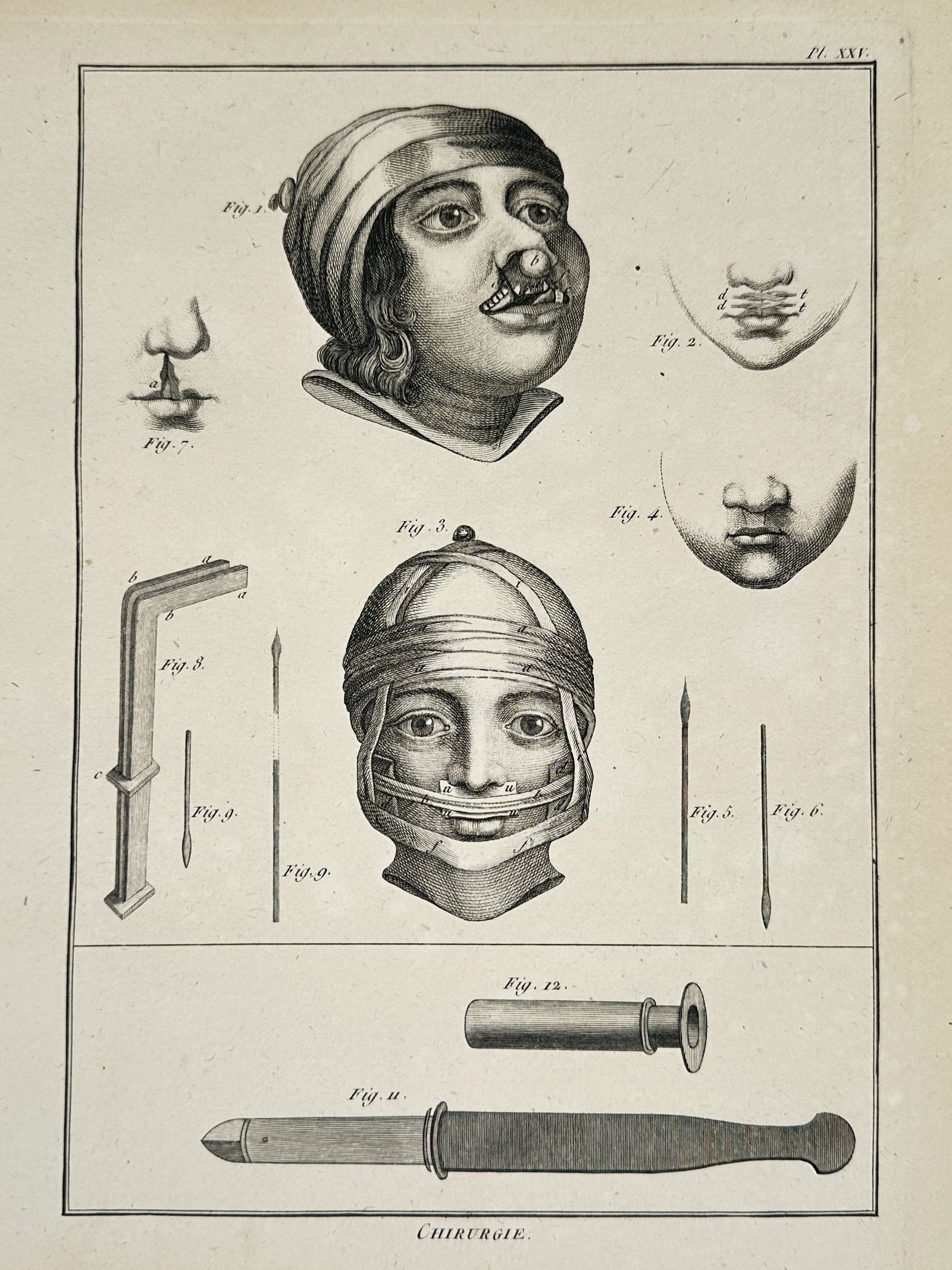 Robert Benard (1734-1785) – Maxillofacial Surgery and Bandaging – Engraving (1771) (1 of 2)