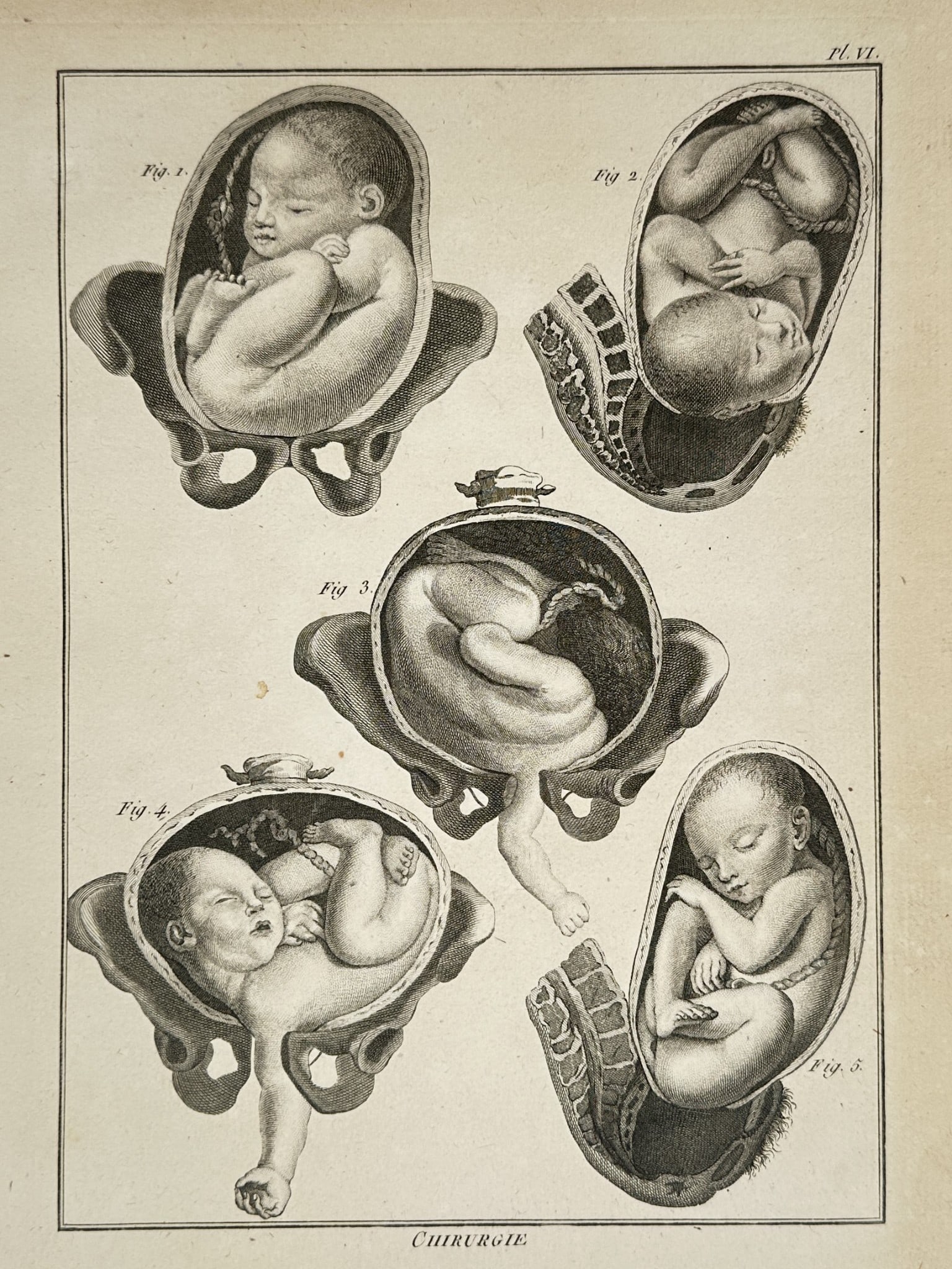 Denis Diderot (1713–1784) – Studies of Fetal Presentation and Childbirth: "Chirurgie" illustrates five distinct anatomical figures showing the positioning of a fetus within the womb and pelvic structure during various stages of pregnancy and labor. The plate depicts the rel