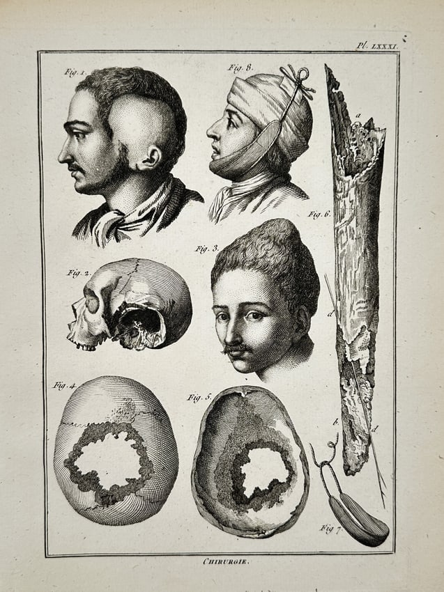 Robert Bénard (1734–1777) – Surgical Studies of the Human Skull – Engraving (1 of 2)