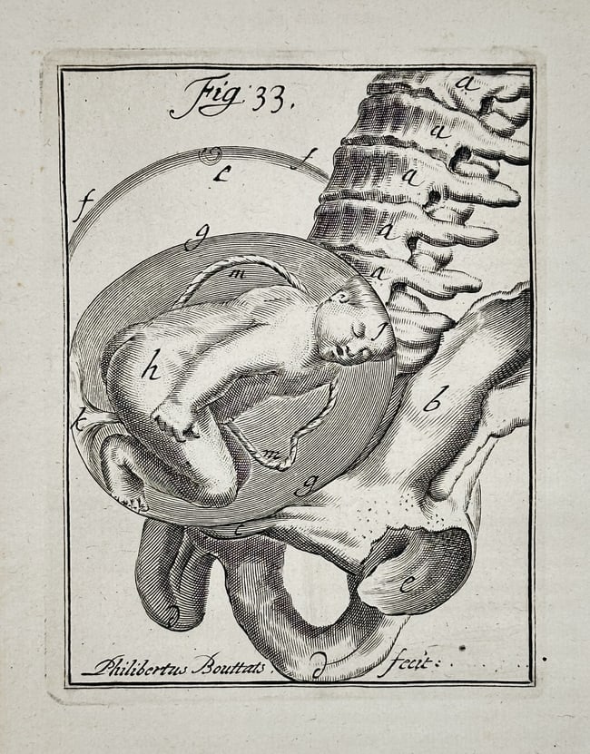 Hendrik van Deventer (1657–1724) - Fetus Presentation in the Pelvis - Copperplate (1 of 2)