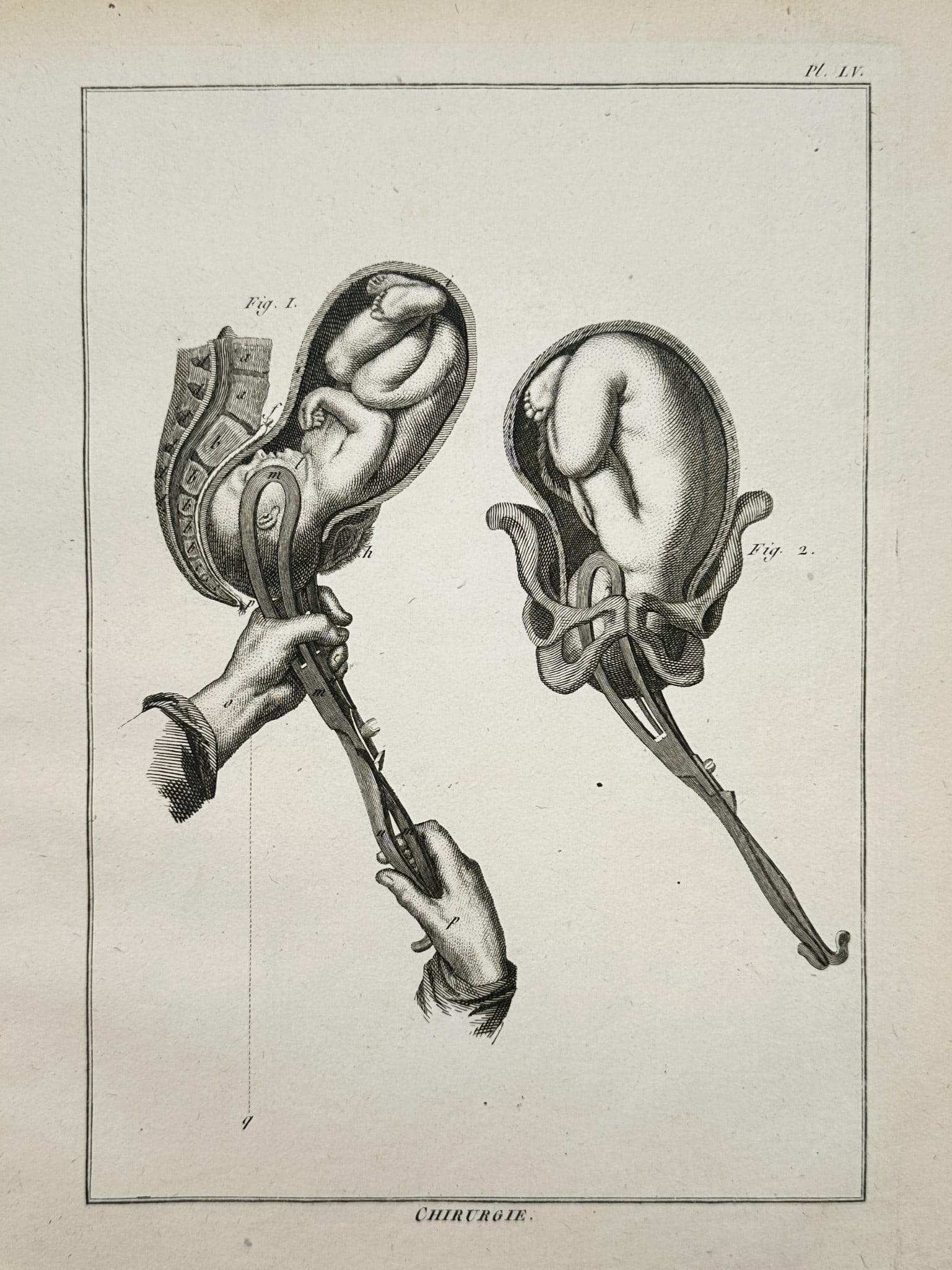 Denis Diderot (1713–1784) – Anatomical Study of Forceps Delivery – Engraving (1 of 2)