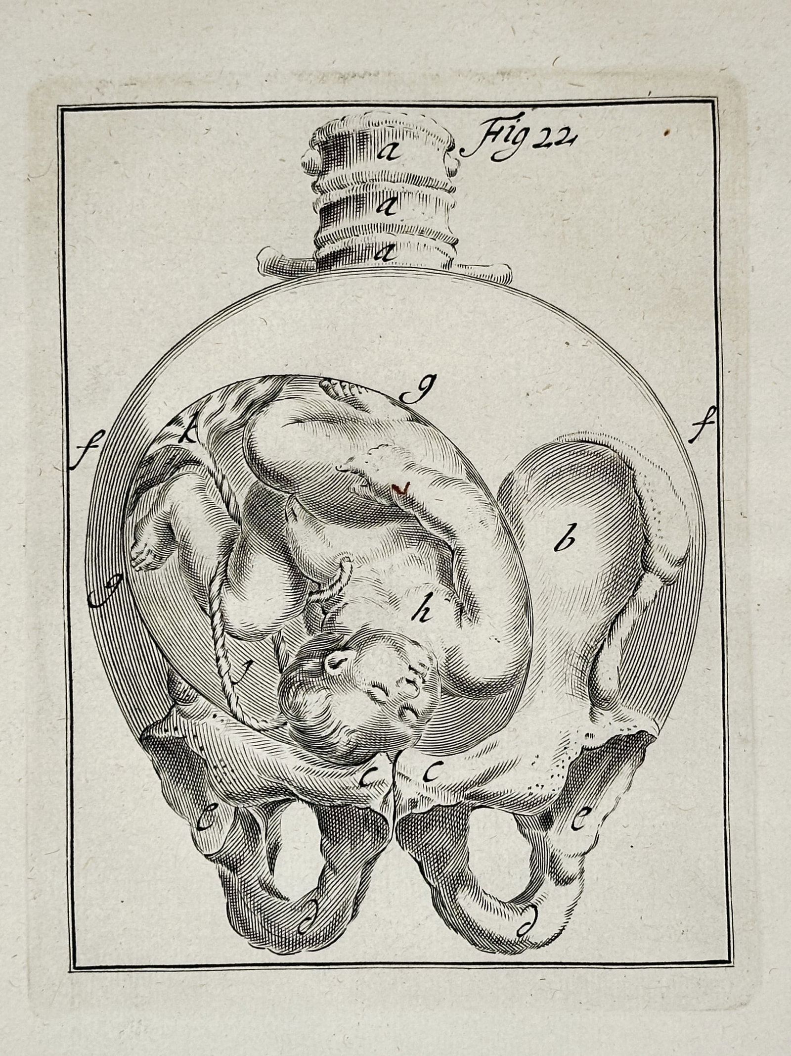 Hendrik van Deventer (1651-1724) – View of a Fetus in the Womb – Engraving (1701): "Observations Importantes sur le Manuel des Accouchemens" illustrates a fetus positioned within the pelvic structure and uterus during pregnancy. This engraving was published in Paris by Pierre-Franco