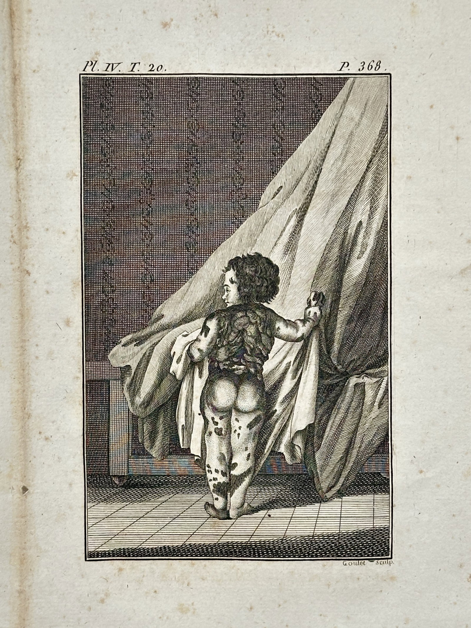 Georges-Louis Leclerc, Comte de Buffon (1707-1788) – Le Pie-Noir – engraving (c. 1770): "Le Pie-Noir" depicts a young child with piebald skin, a condition historically documented in eighteenth-century medical and natural history texts as a rare human variation. This hand-coloured etching