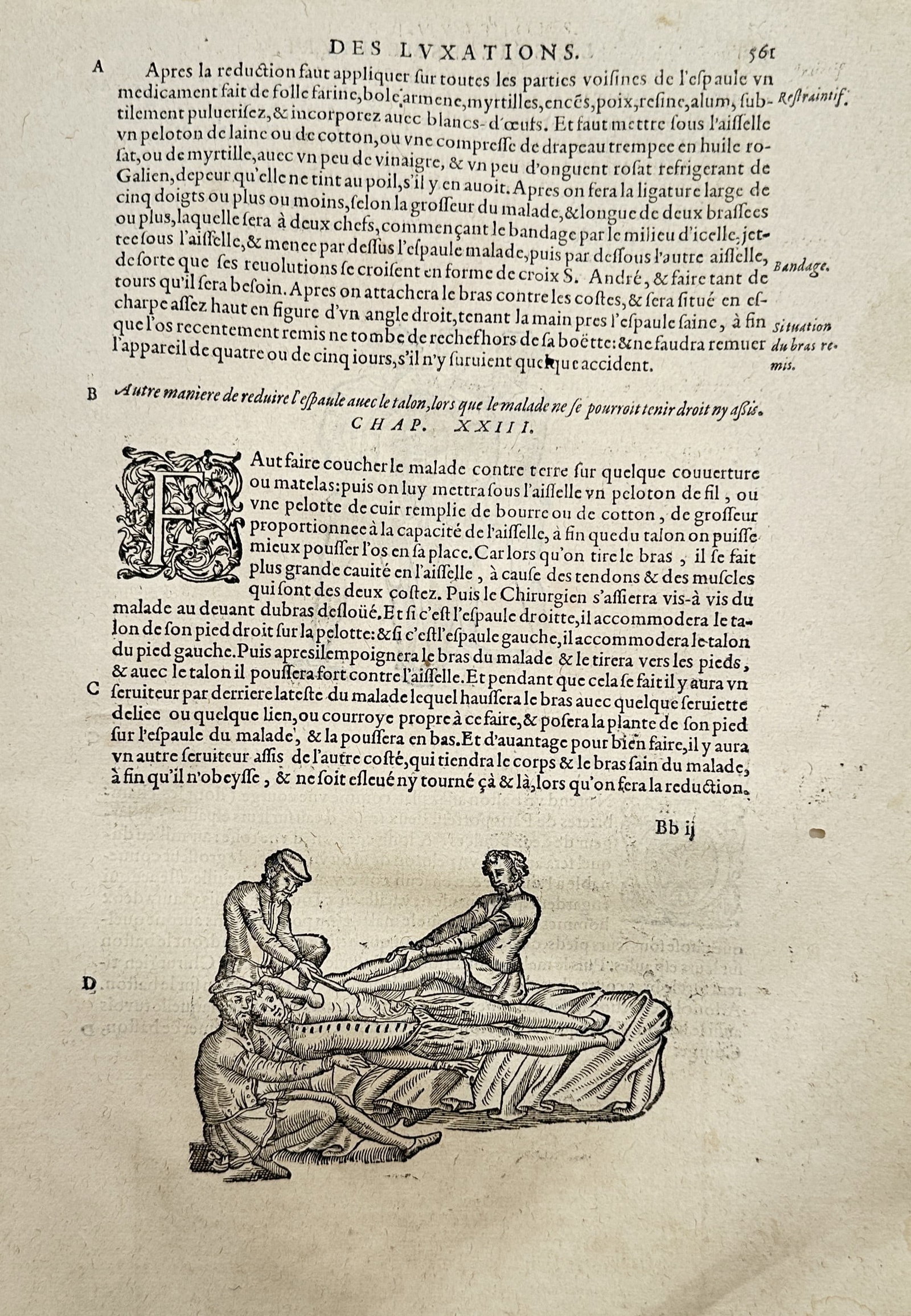 Ambroise Paré (1510–1590) – Surgical Treatment of a Dislocated Shoulder – Woodcut (1585) (1 of 2)