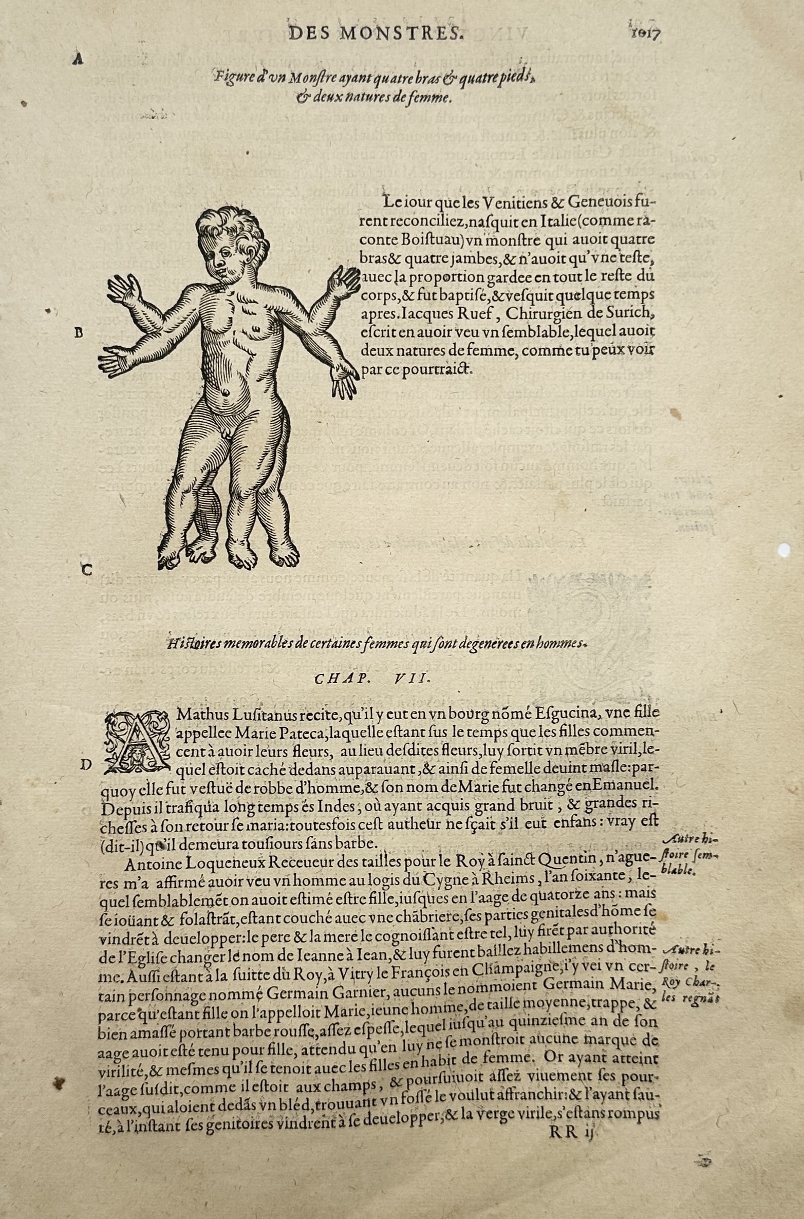 Ambroise Paré (1510–1590) – Teratological Study of a Conjoined Twin Monster – Woodcut (1585) (1 of 2)