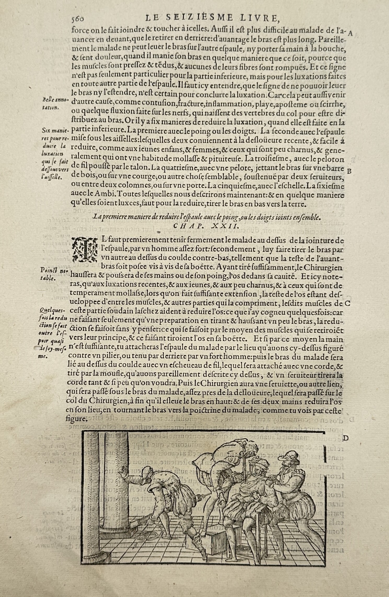Ambroise Paré (1510–1590) – Medical Study of Shoulder Dislocation Reduction – Woodcut (1585) (1 of 2)