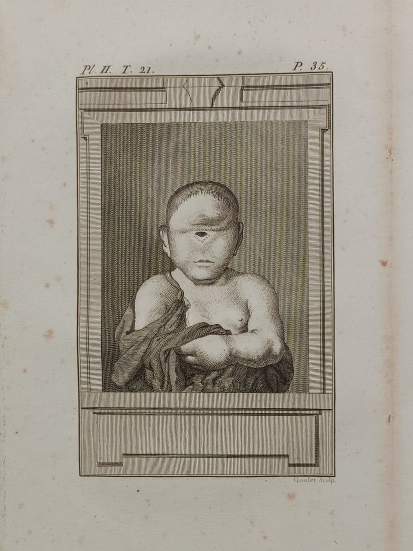 Abbé Prévost – Medical Study of a Cyclopia Congenital Malformation – Engraving (18th Century) (1 of 2)