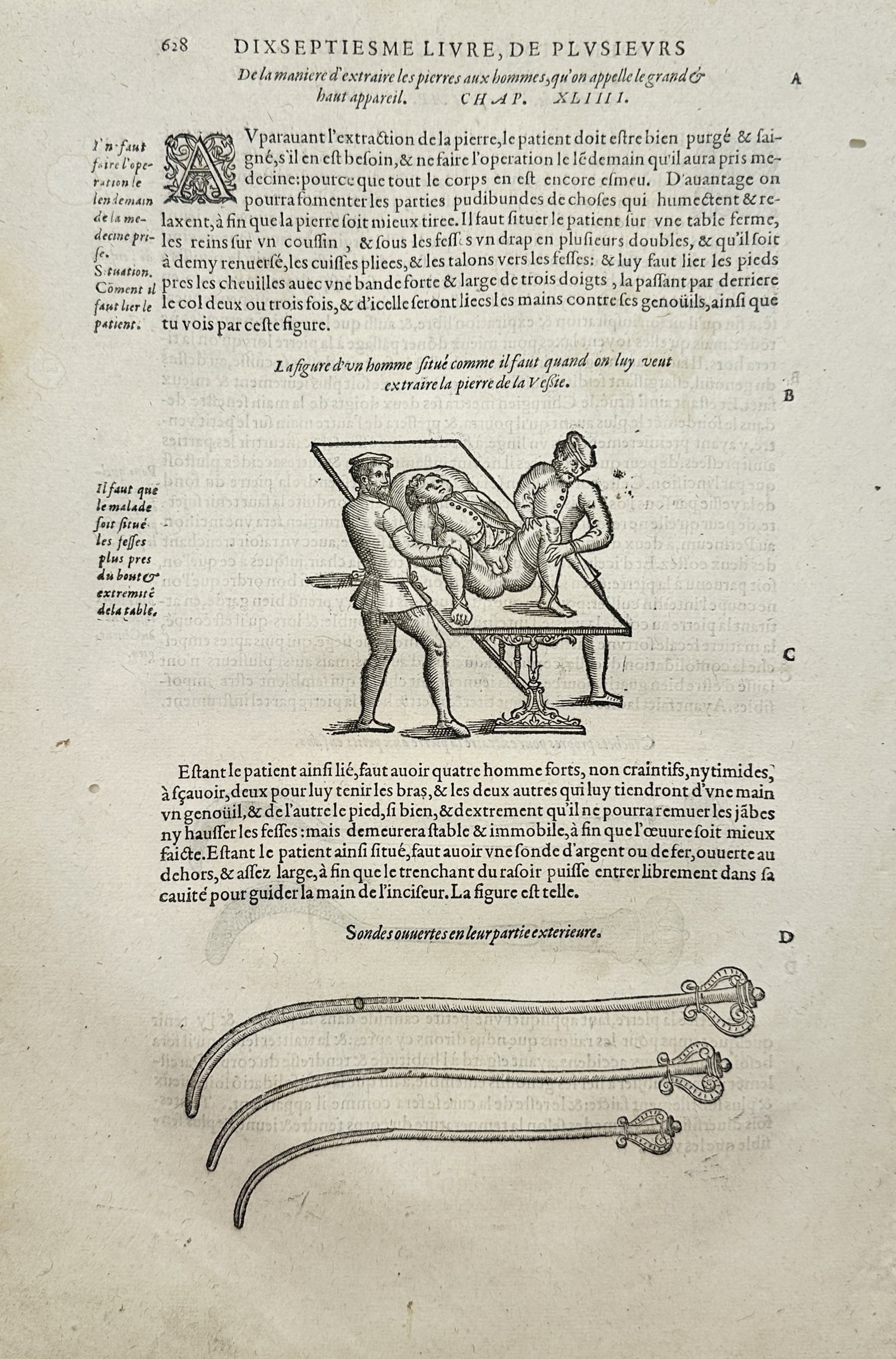 Ambroise Paré – Surgical Extraction of Bladder Stones and Medical Instruments – Woodcut (1 of 2)