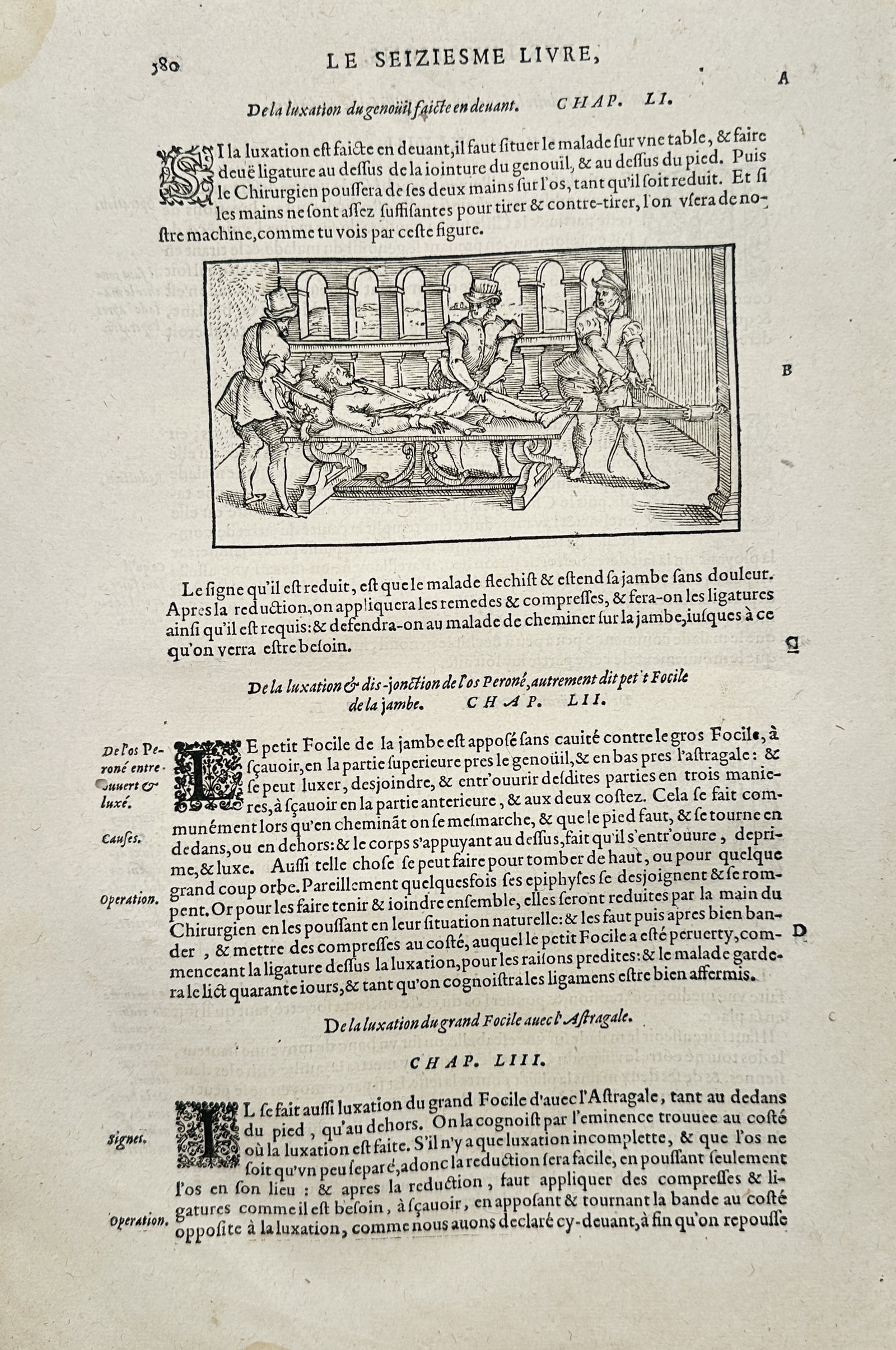Ambroise Paré – Treatment of a Dislocated Knee Using Traction – Woodcut (16th Century): "De la Luxation du Genoüil Faicte en Deuant" This medical illustration depicts a surgical procedure where medical practitioners use mechanical traction and ligatures on a table to reduce a dislocated