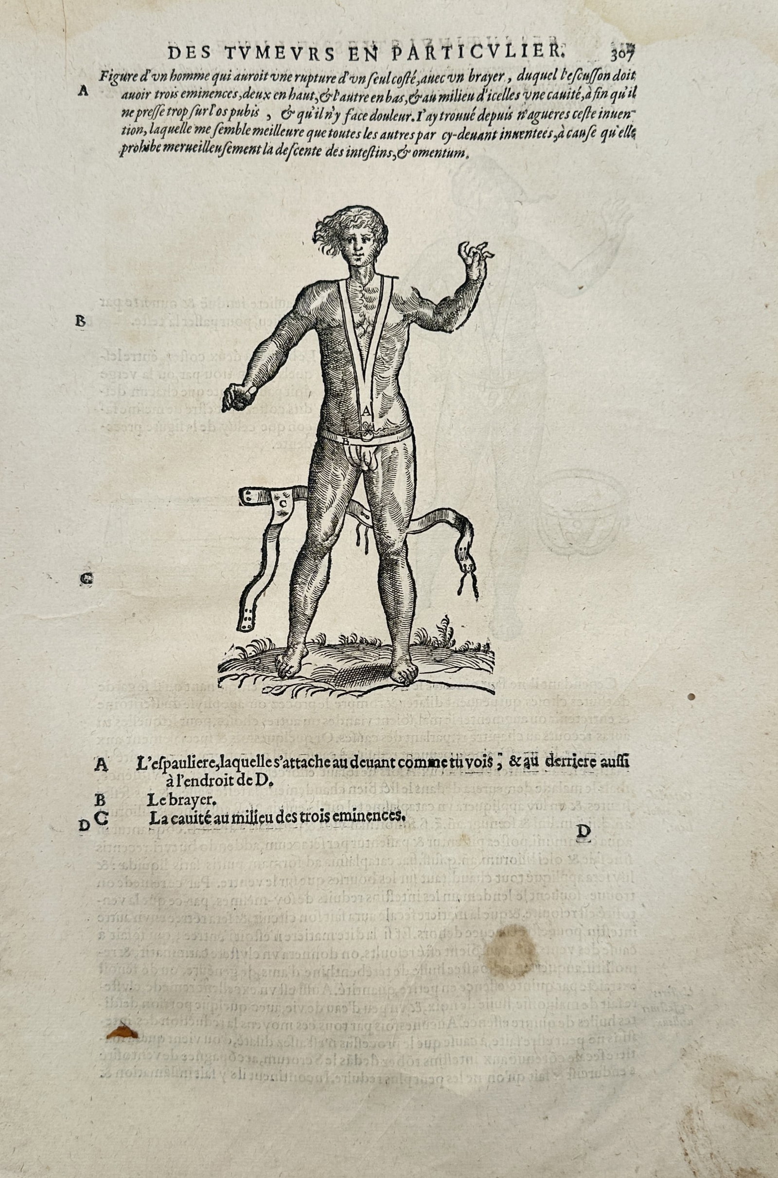 Ambroise Paré – Medical Truss for Hernia Treatment – Woodcut (16th Century) (1 of 2)