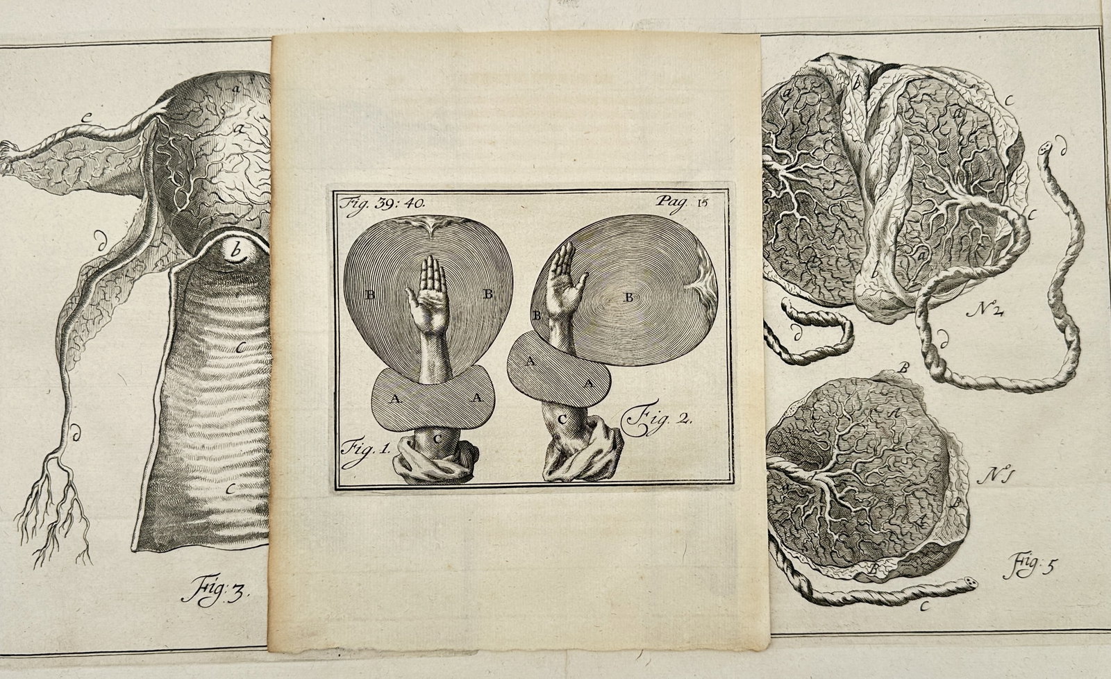 Hendrik van Deventer – Set of 3: Anatomical Studies of Obstetrics and Embryology – Engravings: "The Art of Midwifery." This work features medical illustrations showcasing detailed anatomical diagrams of the female reproductive system and manual obstetrical maneuvers used during childbirth along