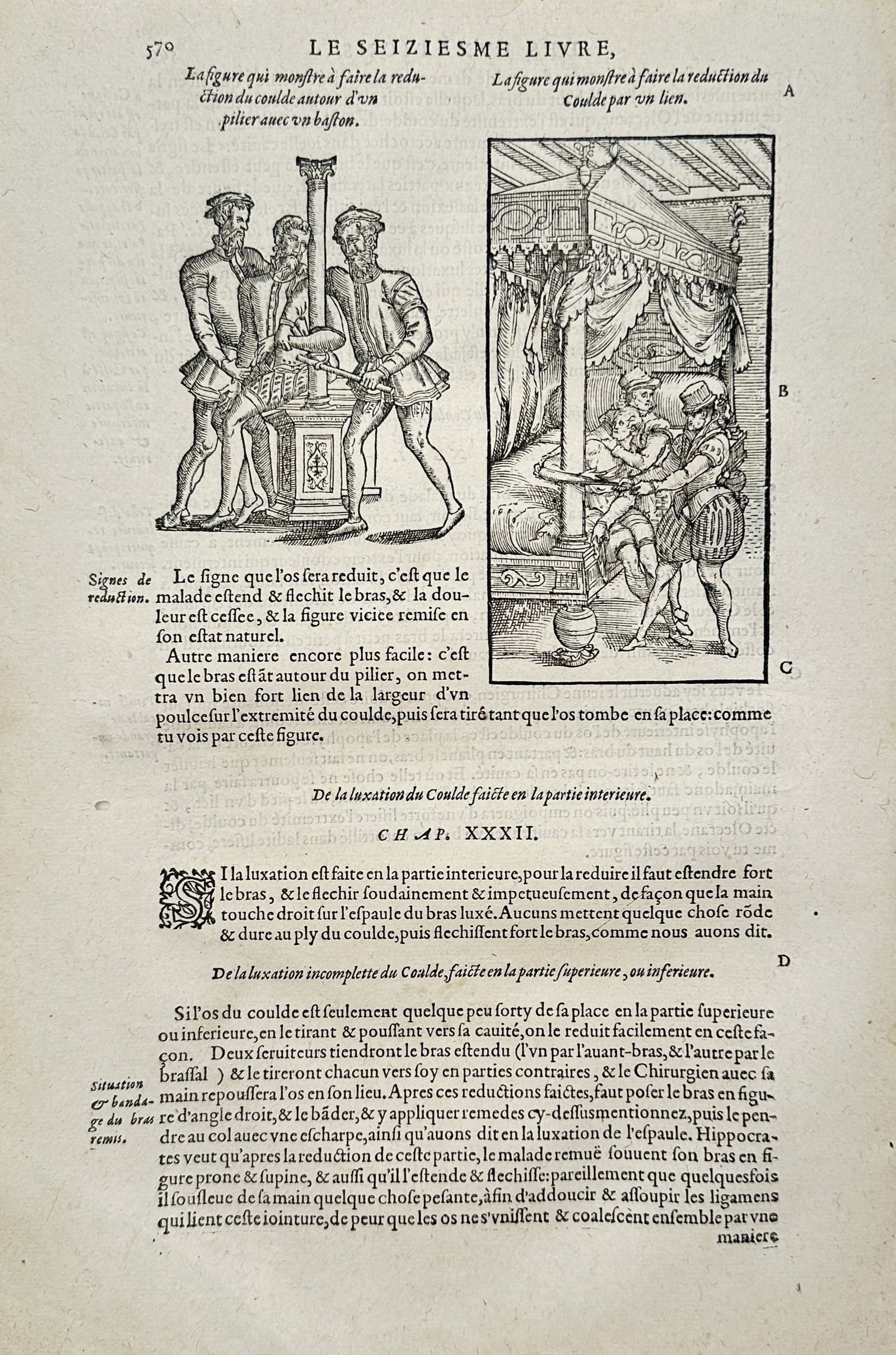 Ambroise Paré – Medical Illustration of Elbow Traction and Reduction – Woodcut (16th Century) (1 of 2)