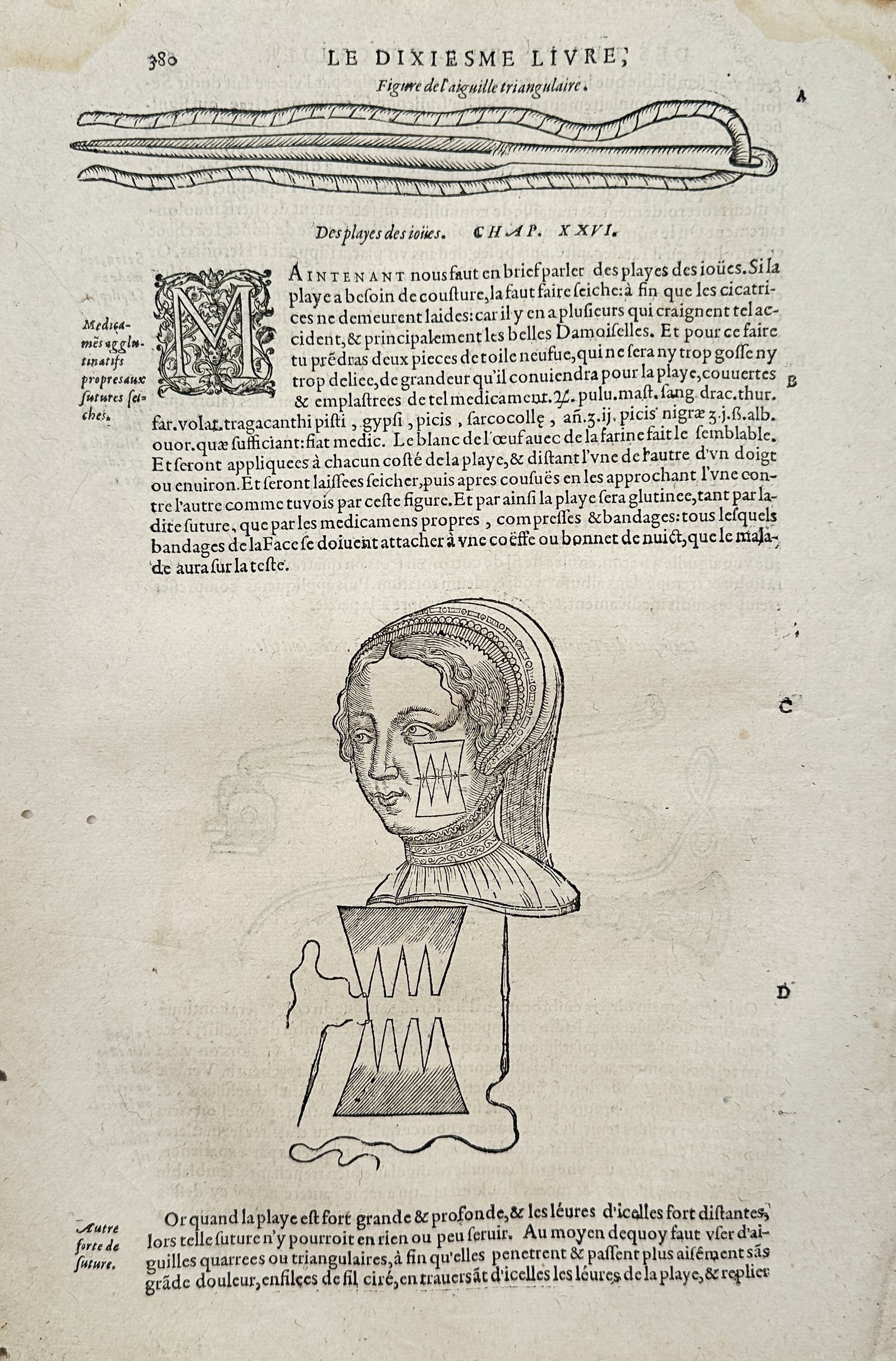 Ambroise Paré – Medical Illustration of Facial Sutures and Surgical Needles – Woodcut (1 of 2)