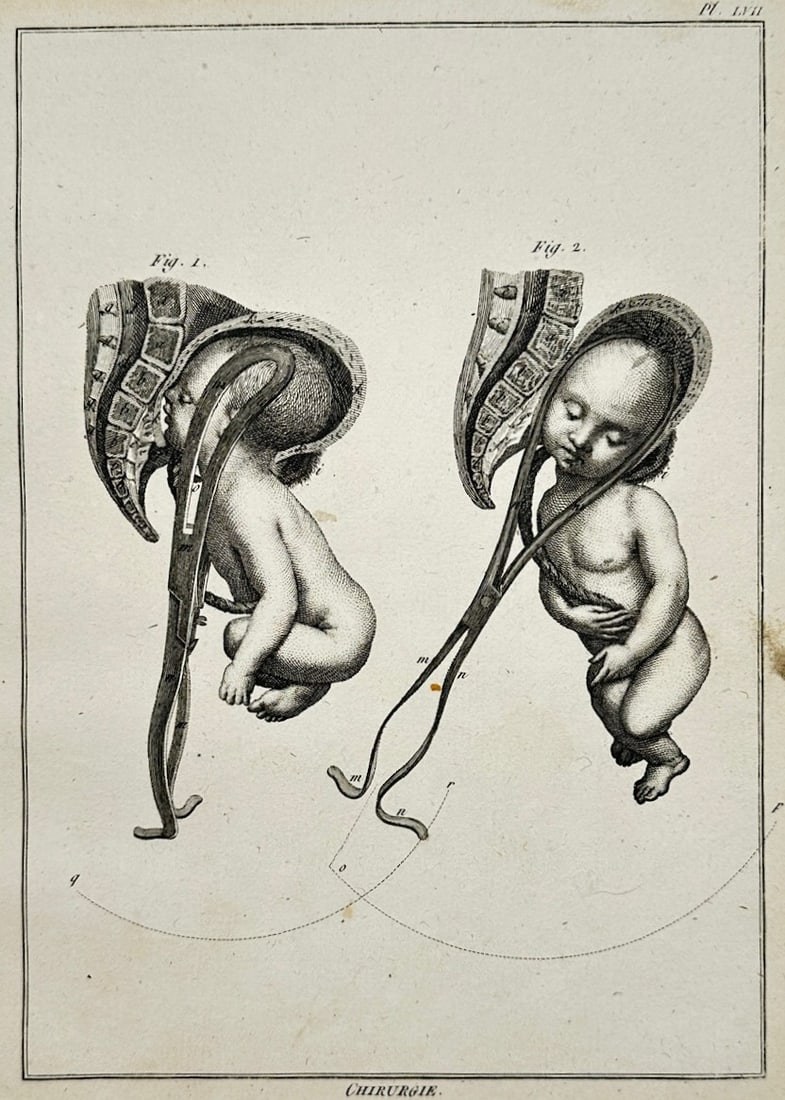 Denis Diderot – Surgical Studies of Childbirth – Engraving (18th Century): "Surgical Studies of Childbirth" This engraving displays a scientific compilation of obstetrical procedures, illustrating the use of surgical forceps during a childbirth delivery. The work was publish