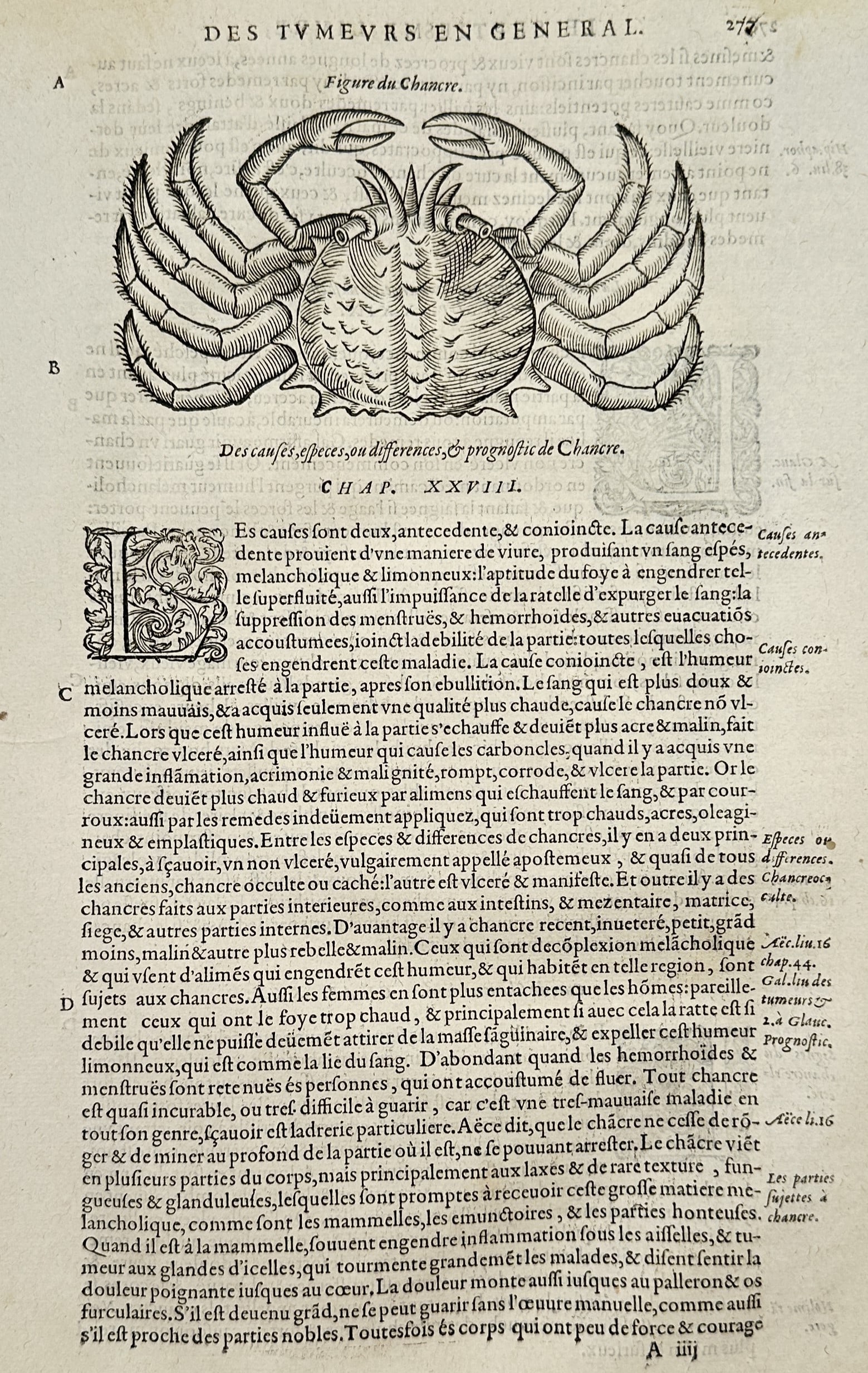 Ambroise Paré – Study of a Crab – Woodcut (16th Century): "Figure of the Cancer" This medical illustration depicts a detailed woodcut of a crab representing the classical symbol and terminology for a tumor within a page of Renaissance French anatomical text.