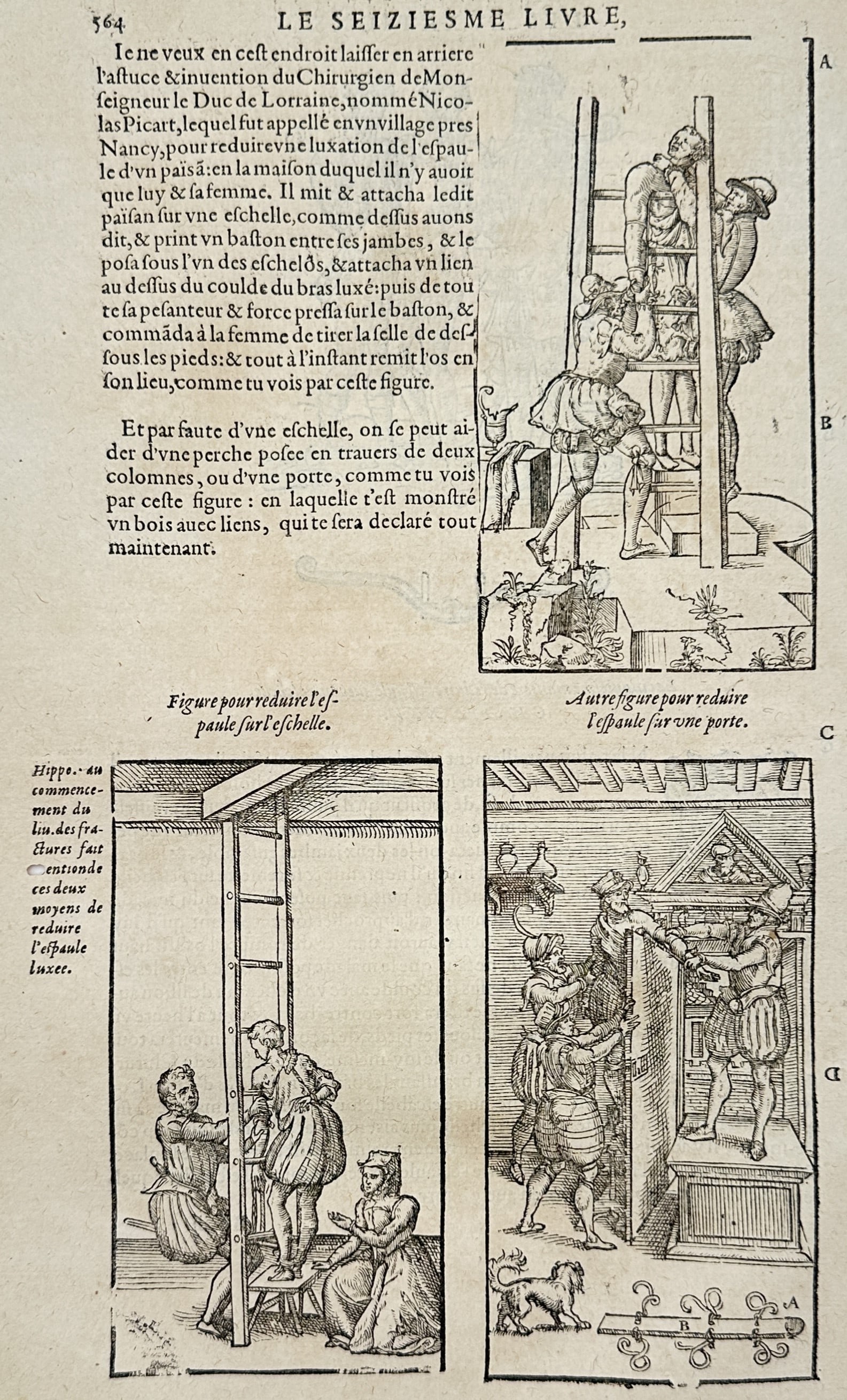 Ambroise Paré – Reducing a Dislocated Shoulder – Woodcut (16th Century): "Methods for Reducing a Dislocated Shoulder" This medical print illustrates historical surgical techniques for reducing a dislocated shoulder using ladders and doors. The work is from a comprehensive 