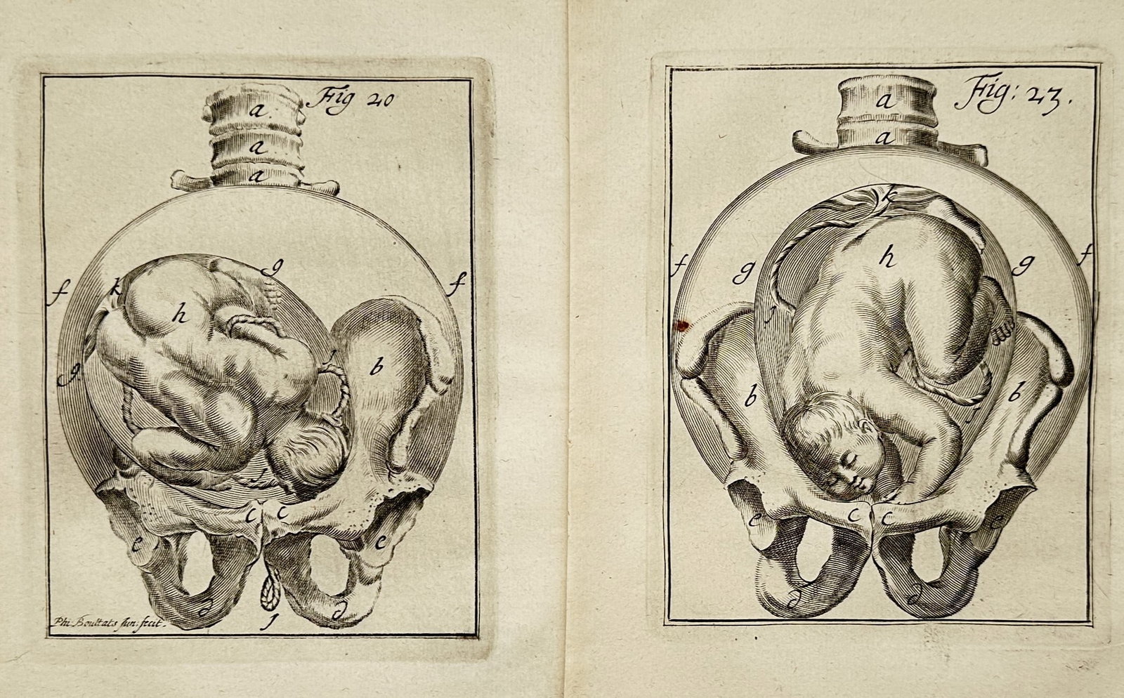 Denis Diderot – Set of 2: Fetal Positions in the Womb – Engravings (18th Century): "Fetal Positions in the Womb" depicts medical illustrations demonstrating the anatomical presentation of a fetus within the maternal pelvis during pregnancy. Published during the eighteenth century as