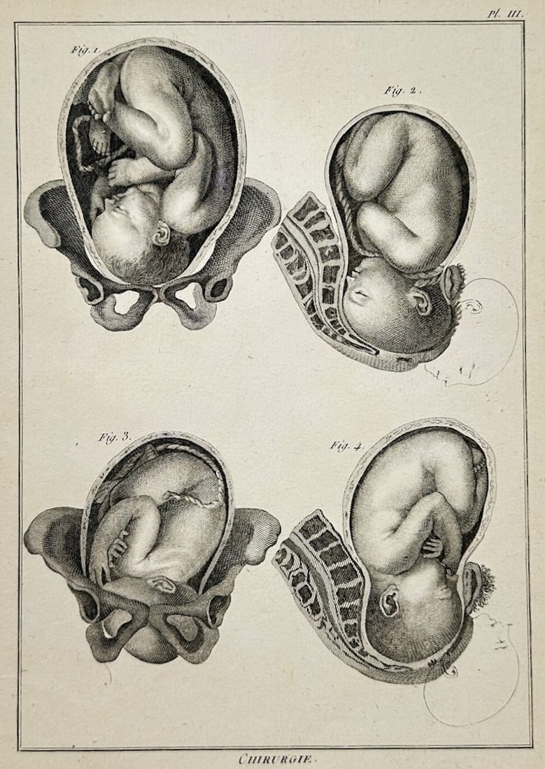 Denis Diderot – Medical Study of Fetal Positions – Engraving (18th Century): "Surgery" This anatomical print illustrates several clinical studies of fetal positions in the womb during childbirth within the maternal pelvis. The work was published during the eighteenth century a