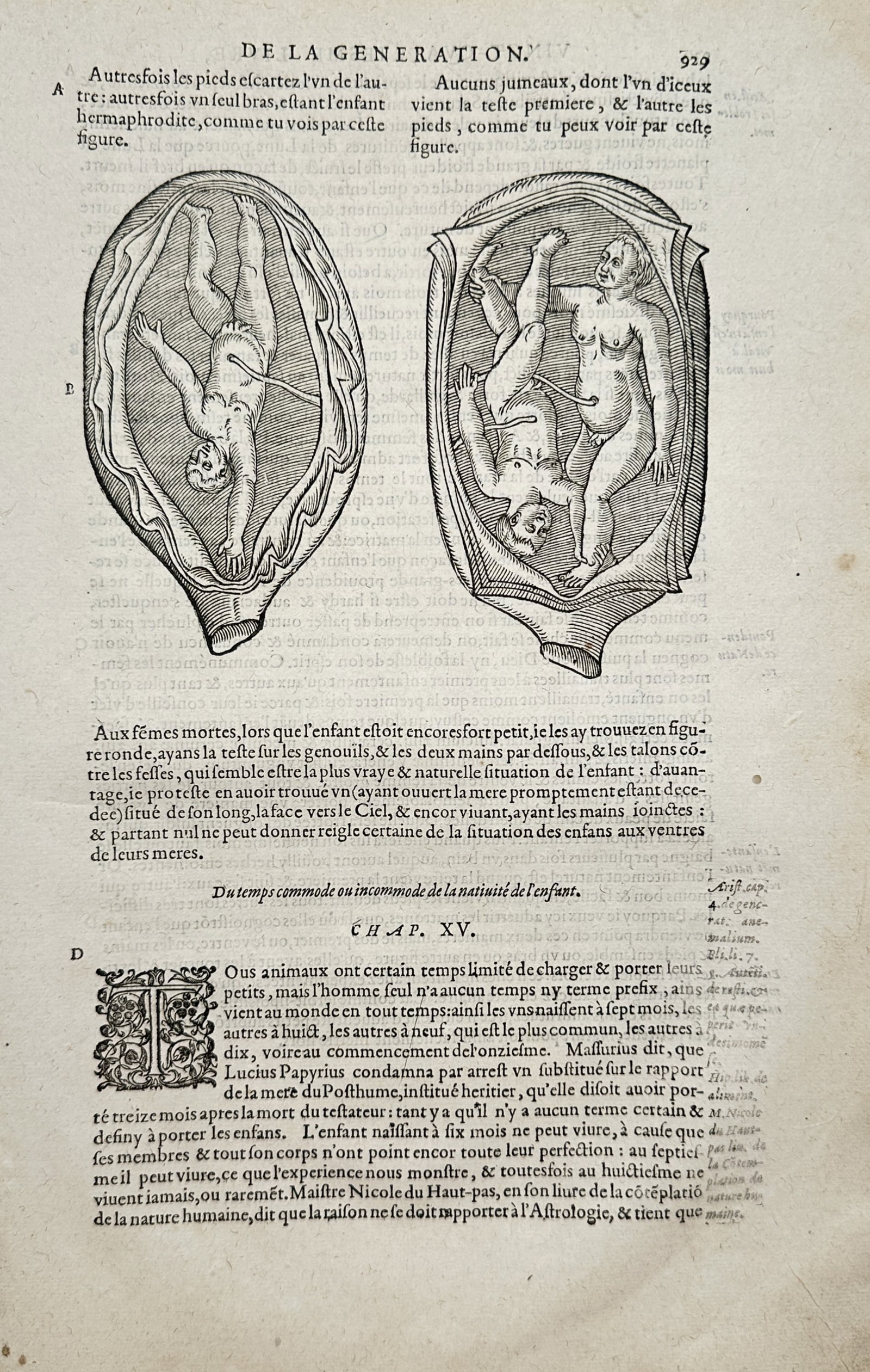 Ambroise Paré – Anatomical Study of Fetal Positions in the Womb – Woodcut (16th Century) (1 of 2)