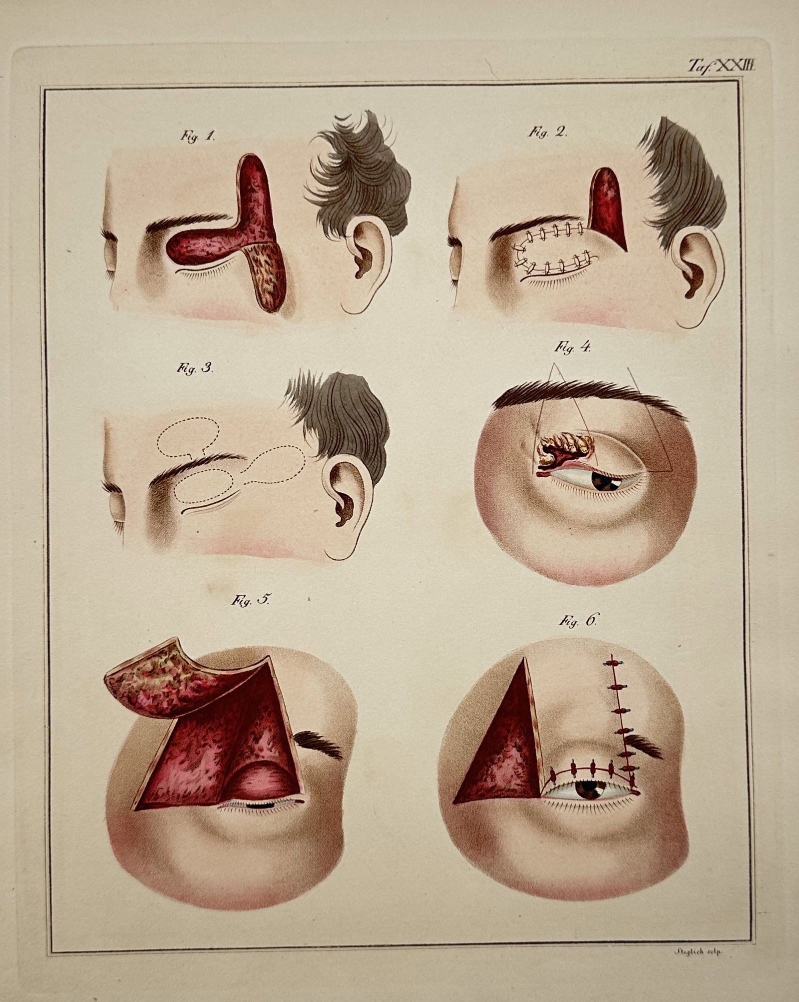 Friedrich August von Ammon – Surgical Study of Ophthalmic and Blepharoplastic Procedures (1 of 2)