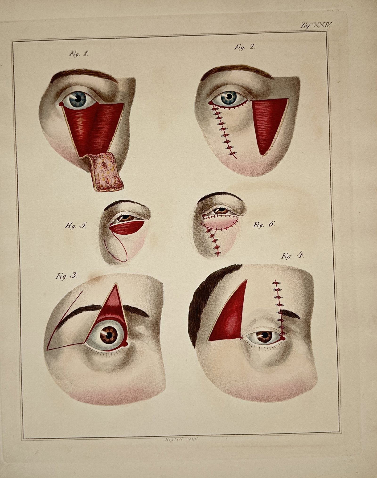 Friedrich August von Ammon – Surgical Study of Eyelid and Facial Reconstructive Procedures (1 of 2)