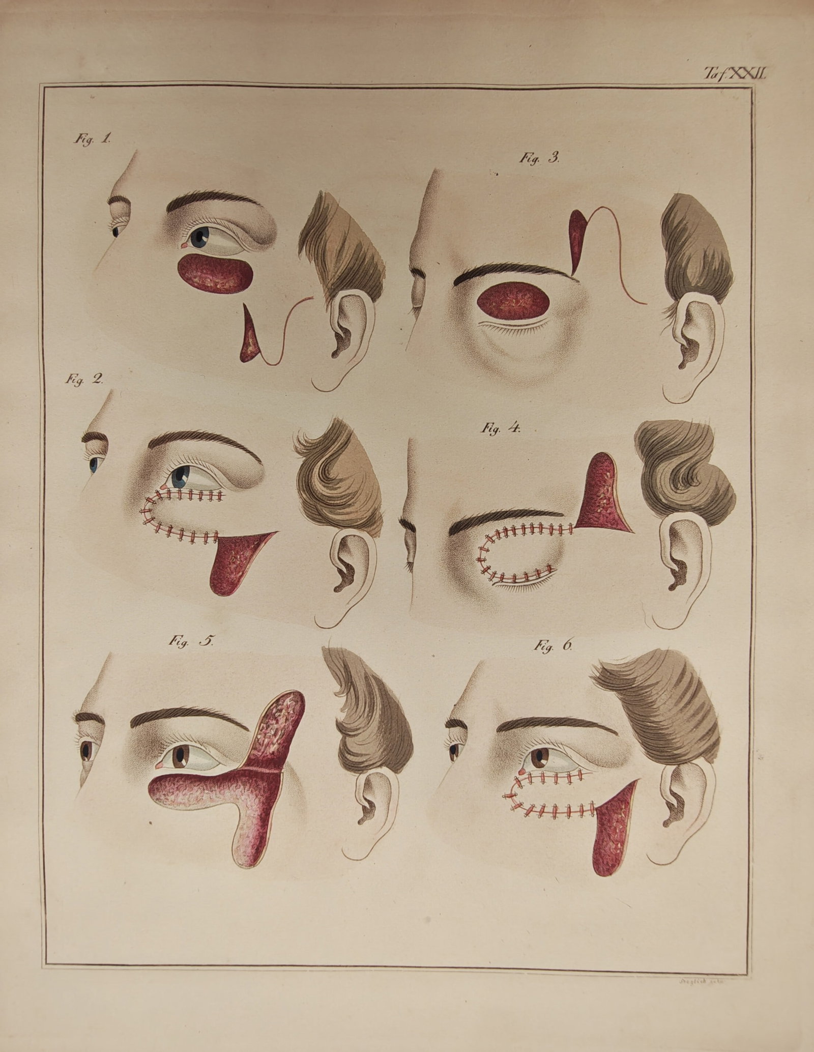 C. Steglich – Medical Study of Blepharoplasty and Eyelid Reconstructive Surgery – Engraving: "Surgical Reconstructive Procedures of the Eyelids" illustrates step-by-step surgical techniques for blepharoplasty, detailing skin flap incisions, graft transpositions, and precise suturing patterns 