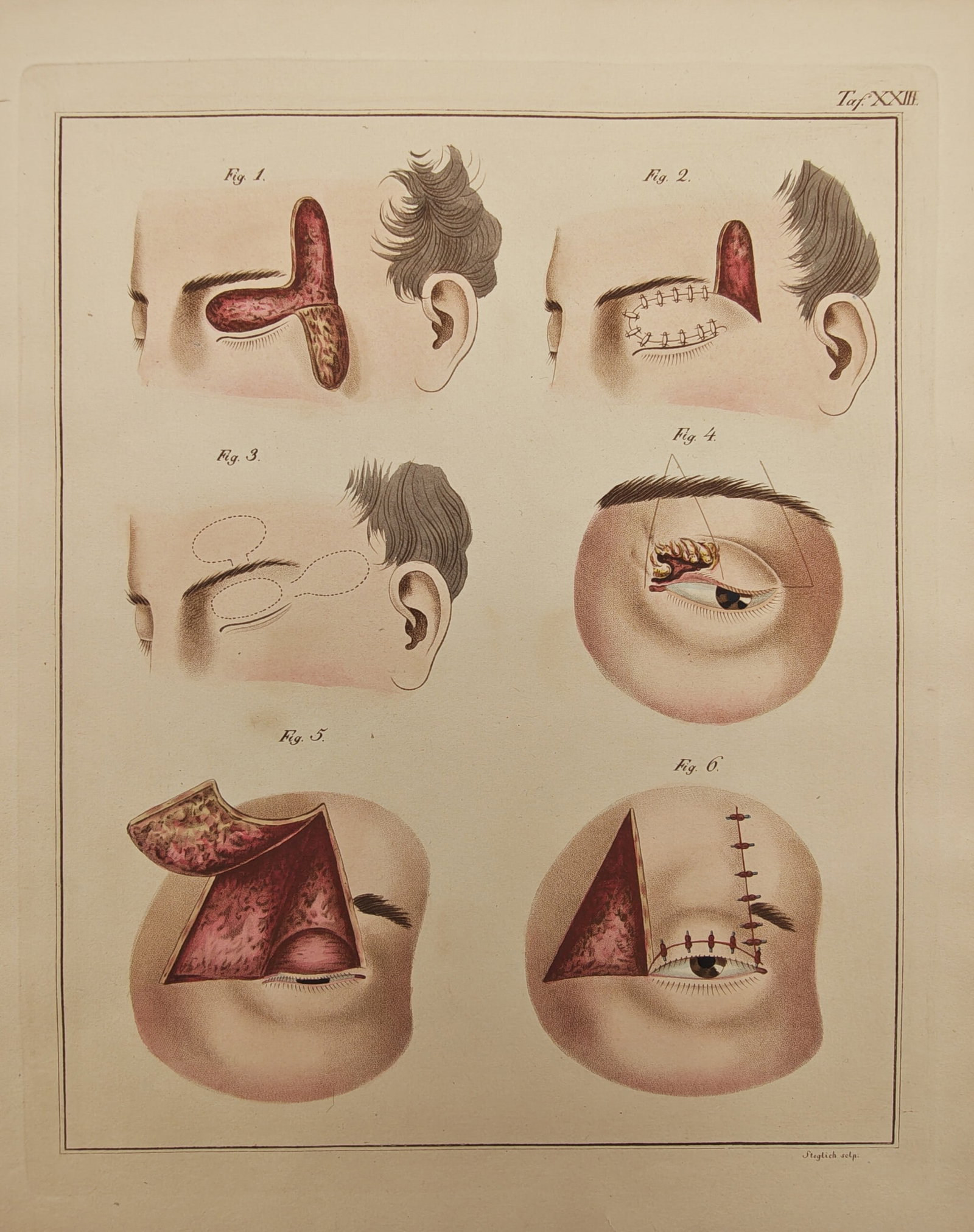 C. Steglich – Medical Study of Forehead Flaps and Ophthalmic Plastic Surgery – Engraving: "Surgical Procedures for Upper Eyelid and Forehead Reconstruction" illustrates specialized surgical interventions including pedicle flap harvesting, forehead tissue mobilization, excision of eyelid le