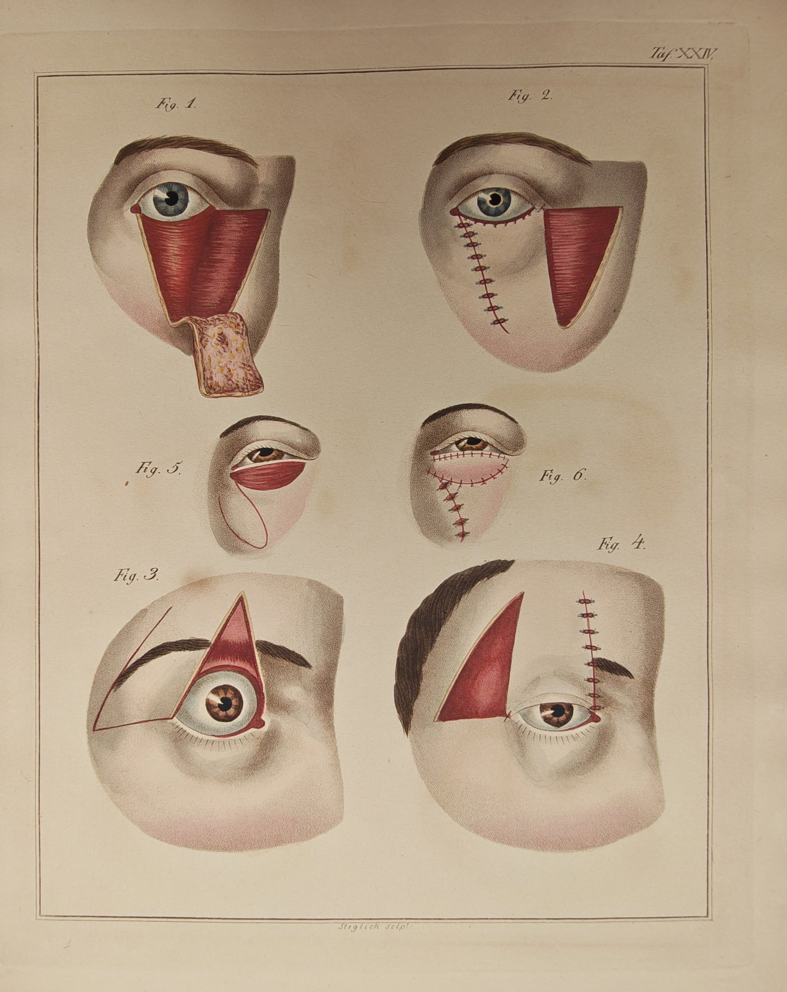 C. Steglich – Medical Study of Blepharoplasty and Eyelid Reconstructive Surgery – Engraving (1 of 2)