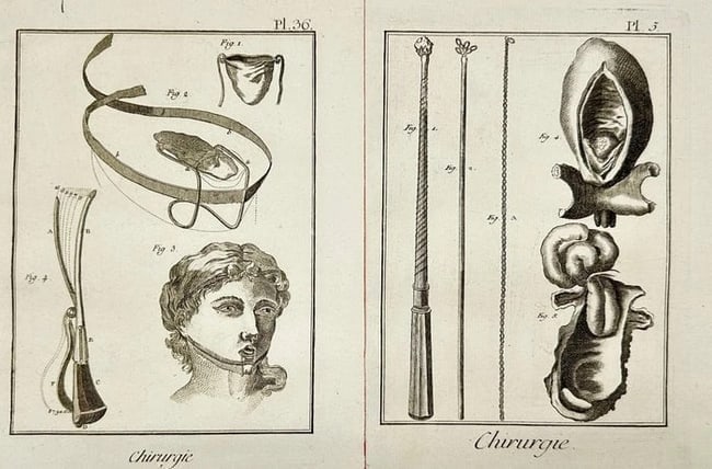 Denis Diderot – Set of 2 Copperplate Engravings of Surgical Instruments: This set of two original copperplate engravings is from the Chirurgie (Surgery) section of Denis Diderot’s Encyclopédie, a cornerstone of Enlightenment knowledge. Plate 36 depicts facial orthopedic