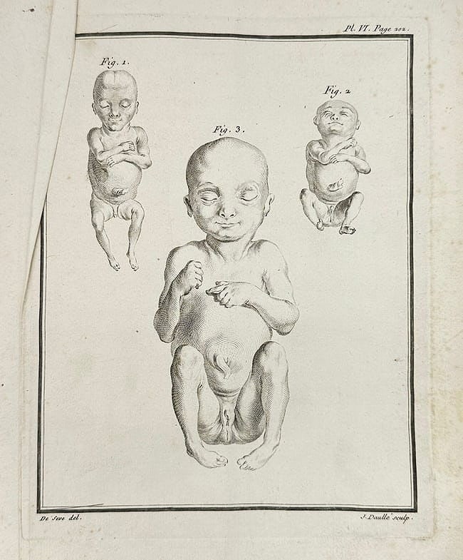 Jacques de Sève – Anatomical Study of Infants with Developmental Anomalies (1 of 3)