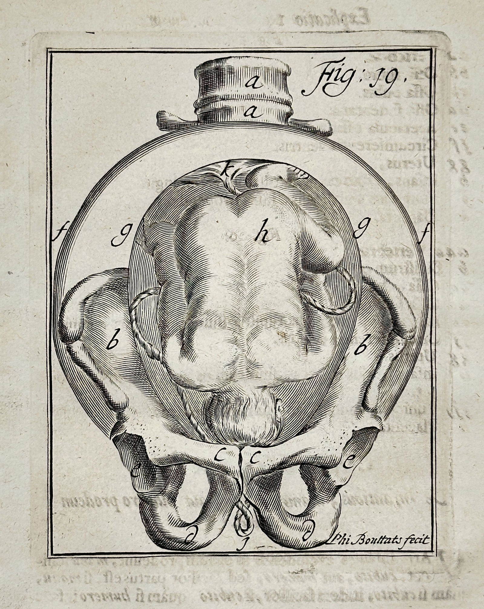 Hendrik van Deventer (1657–1724) – Fetus Presentation in Pelvis – Engraving (c. 1701) (1 of 2)
