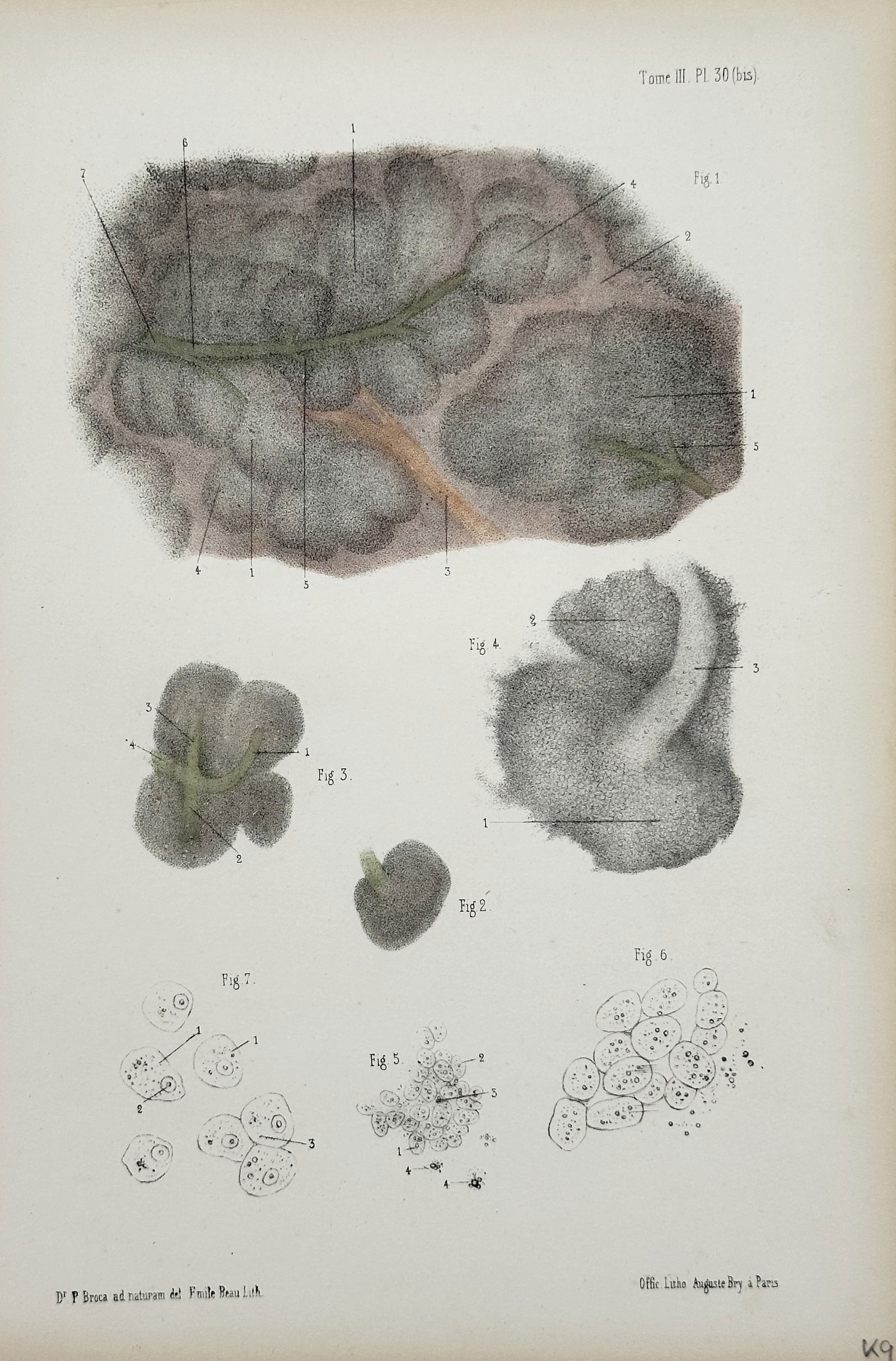 Auguste Bry (Active c. 1830–1860) – Microscopic Anatomy of the Spleen – Engraving (c. 1840): This print is a detailed medical illustration (Plate 50 from Tome III) focusing on the microscopic anatomy of the spleen. The plate displays several figures illustrating the organ's lobulated structur