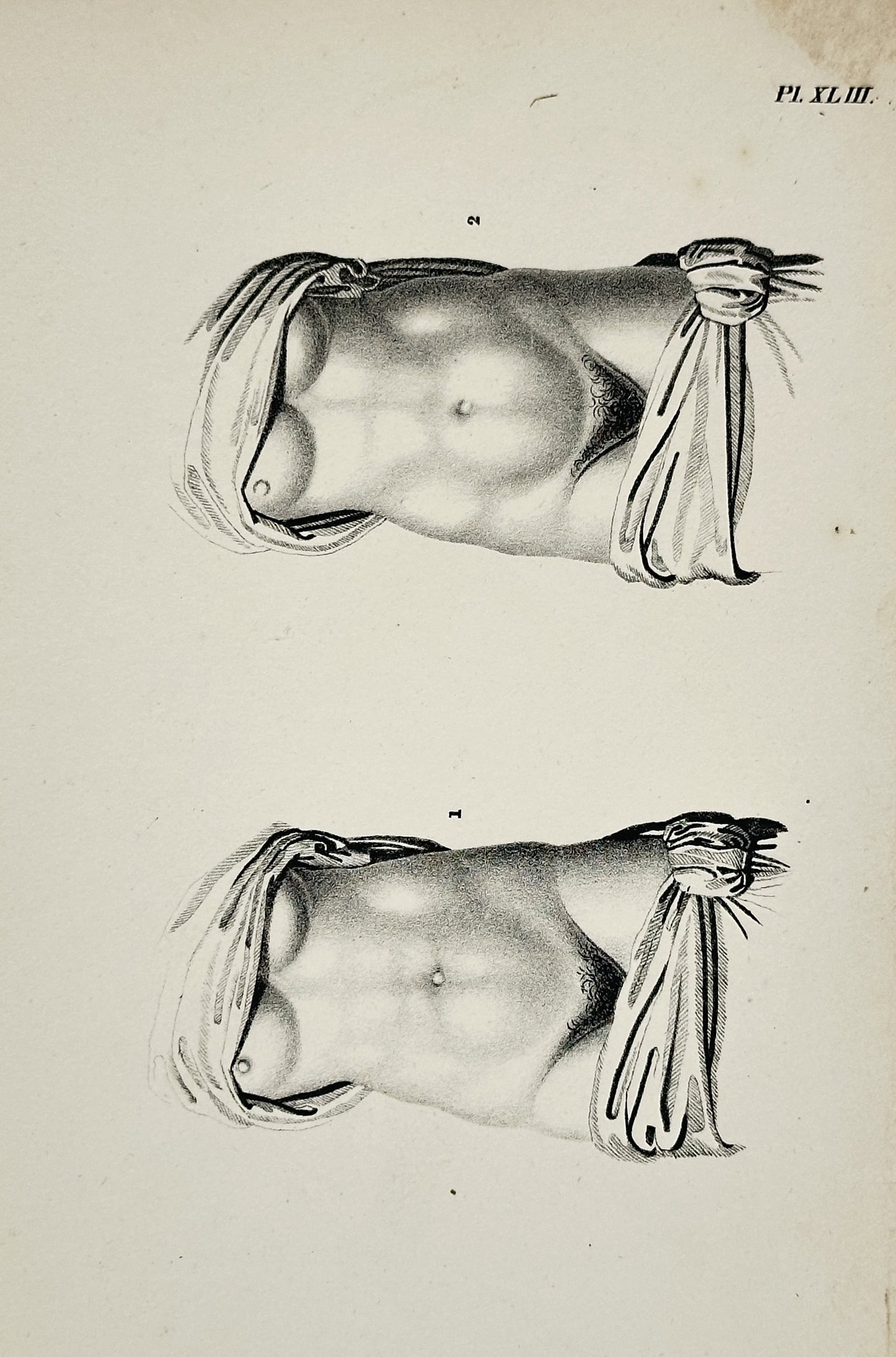 Denis Diderot (1713–1784) – Illustration of Surgical Bandaging for the Torso – Engraving: This engraving is a plate illustrating the proper application of surgical bandaging or binders for the human torso, labeled Pl. XLIII (Plate 43). The image shows two identical views of a person's uppe