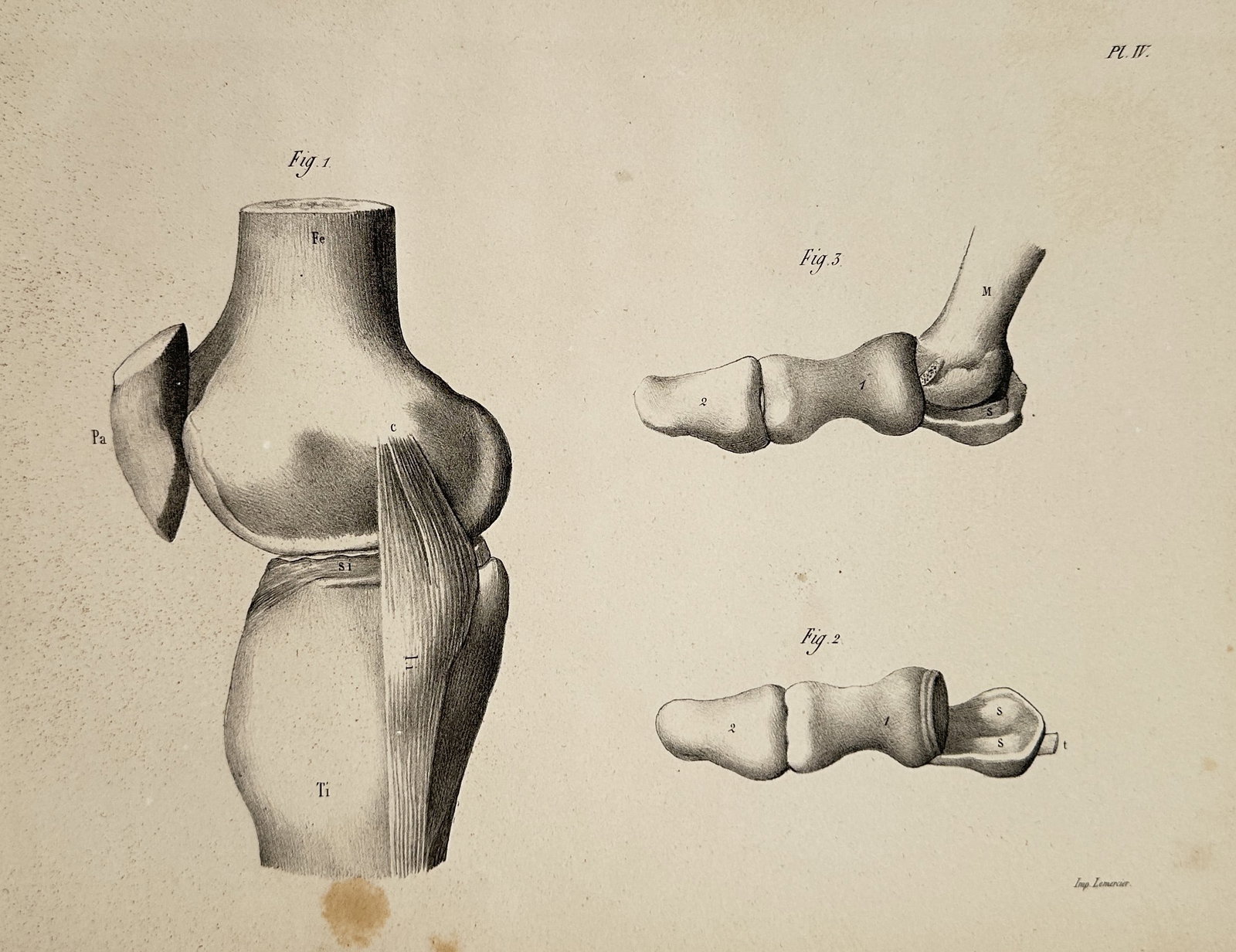 Carl Heitzmann (1836–1896) – Anatomical Study of the Knee and Foot Joints, Plate IV: This lithograph is a scientific illustration detailing the anatomy of the human knee joint and the joints of the foot, published as Plate IV of an anatomical or morphological atlas. Carl Heitzmann was