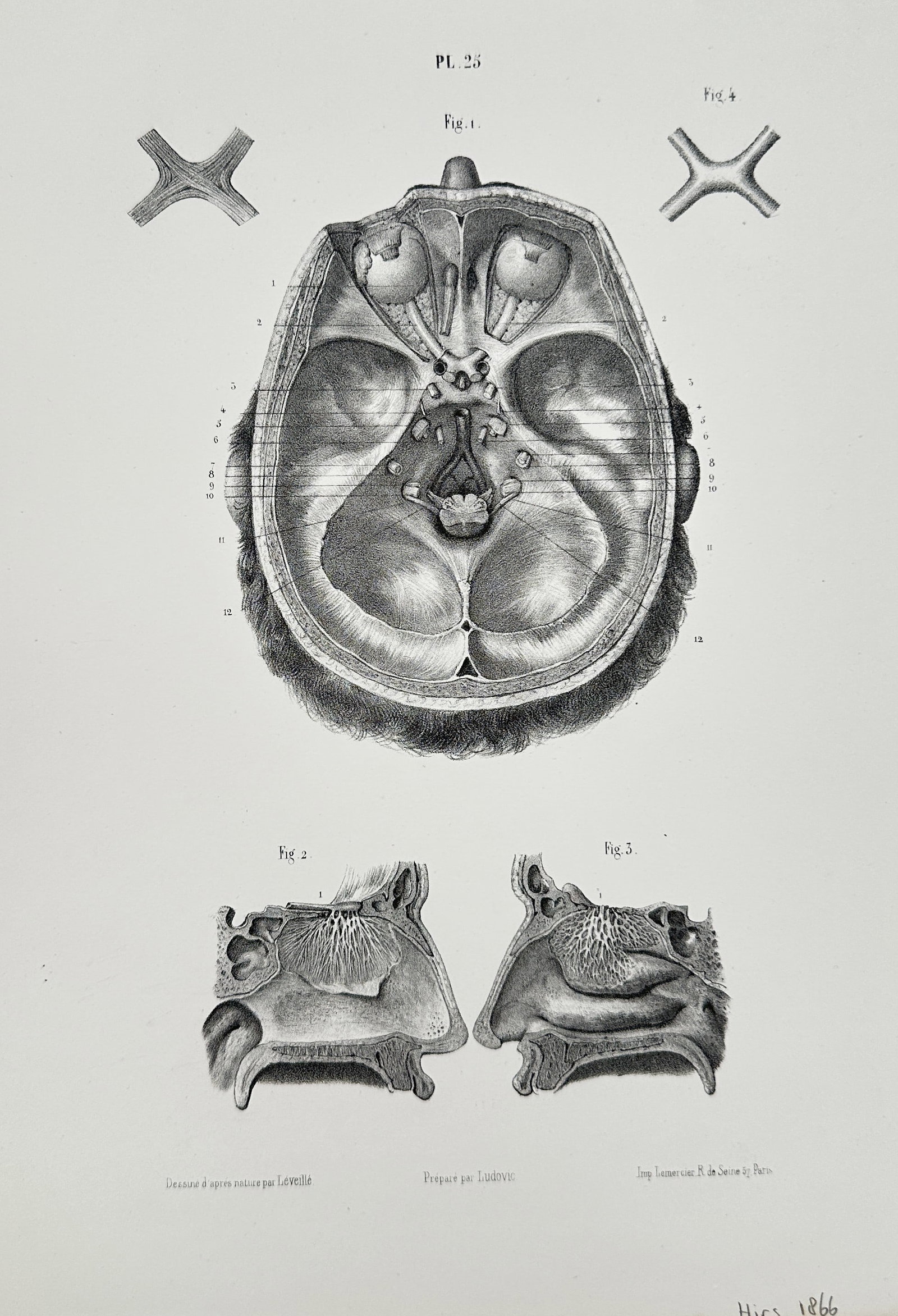 Hirs (19th Century) – Anatomical Study of the Base of the Skull and Nasal Fossae – Engraving: This engraving provides a detailed anatomical study of the human head, featuring a horizontal section of the base of the skull and separate sagittal views of the nasal fossae and sinuses. The plate is