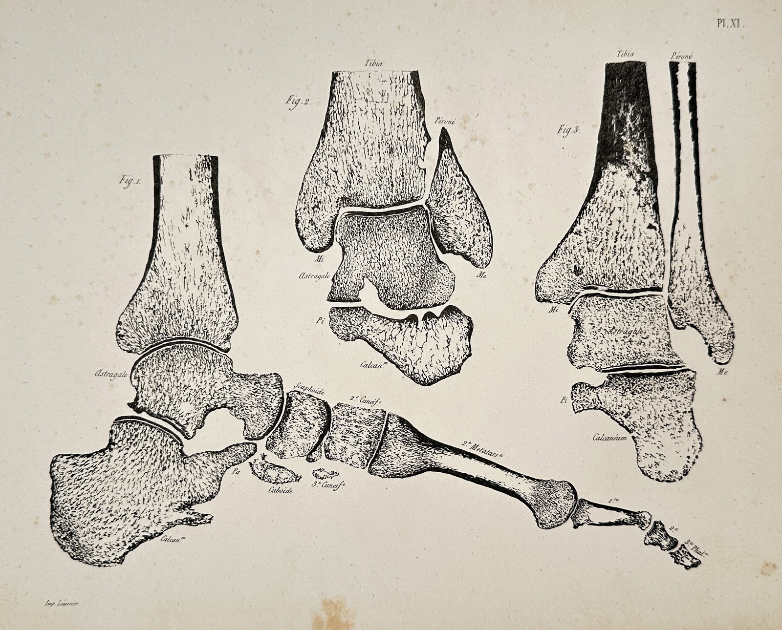 Wilhelm Weber – Anatomy of the Ankle and Foot Bones – Engraving (19th Century): This engraving illustrates the skeletal anatomy of the human ankle and foot, showing medial, anterior, and lateral views of the joint and long bones of the foot. The illustration, labeled with scienti