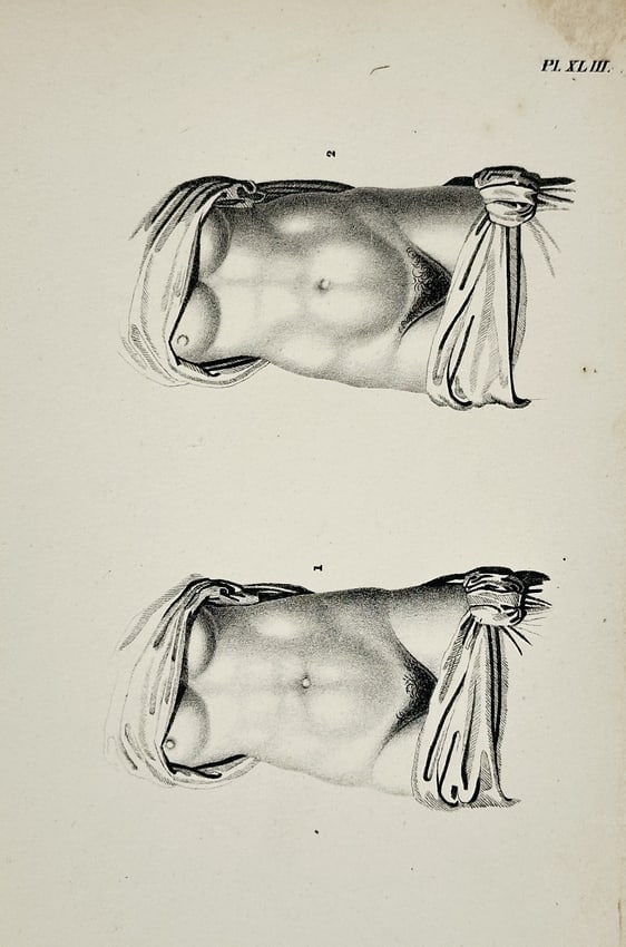 Denis Diderot (1713–1784) – Illustration of Surgical Bandaging for the Torso: This engraving is a plate illustrating the proper application of surgical bandaging or binders for the human torso, labeled Pl. XLIII (Plate 43). The image shows two identical views of a person's uppe