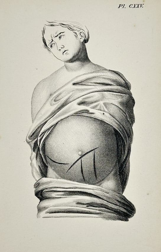 Denis Diderot (1713–1784) – Anatomical Study of a Pregnant Abdomen (Plate CXXV): This print is a detailed anatomical illustration (Plate CXXV). The engraving highlights the external changes and potential skin tension, with lines drawn on the abdomen to suggest possible measurement