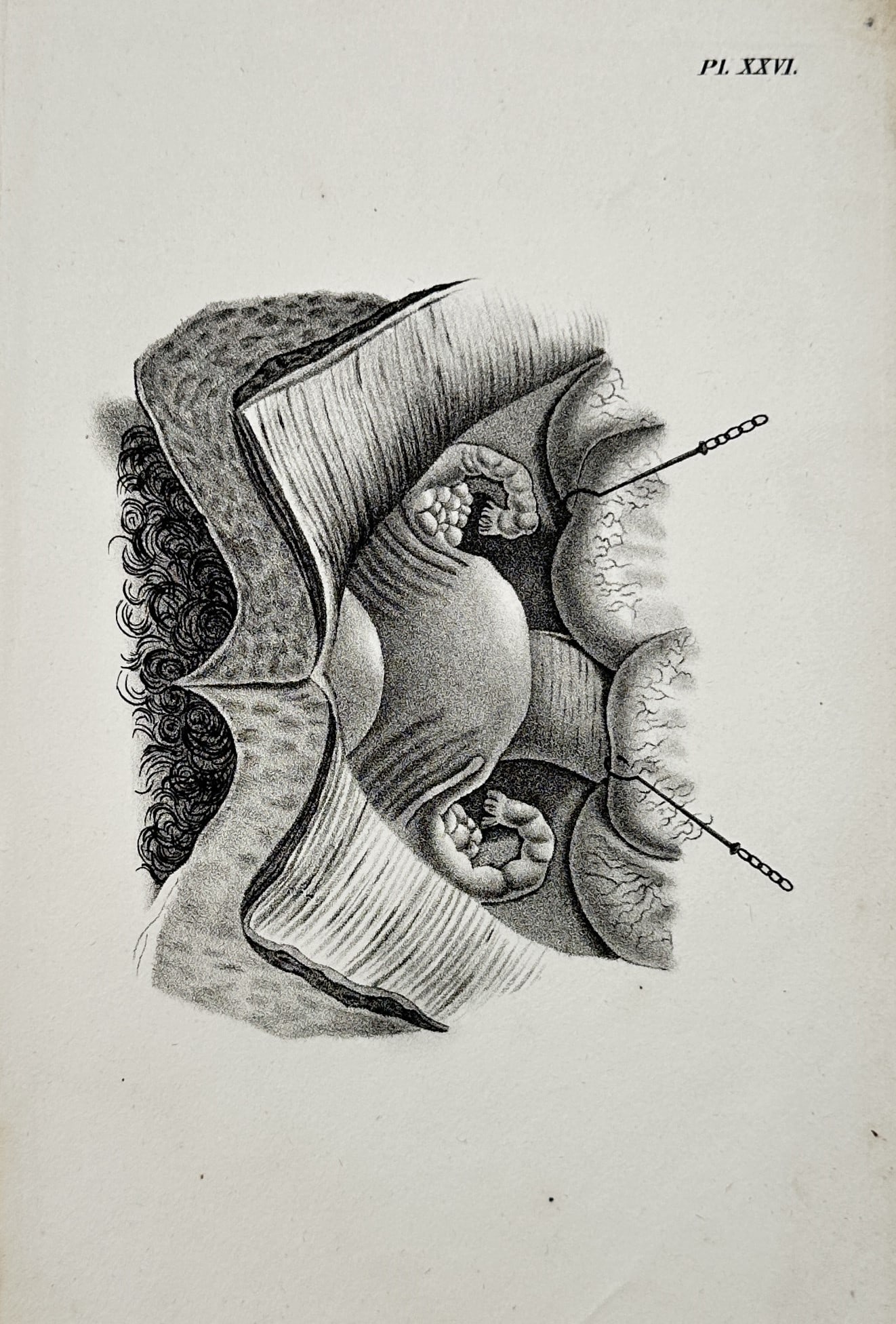 Carl Ernst Bock – Anatomical Study of the Female Reproductive System – Engraving: This engraving depicts a detailed medical dissection of the human female pelvic region, focusing on the internal reproductive organs. The illustration shows the uterus, fallopian tubes, and ovaries in